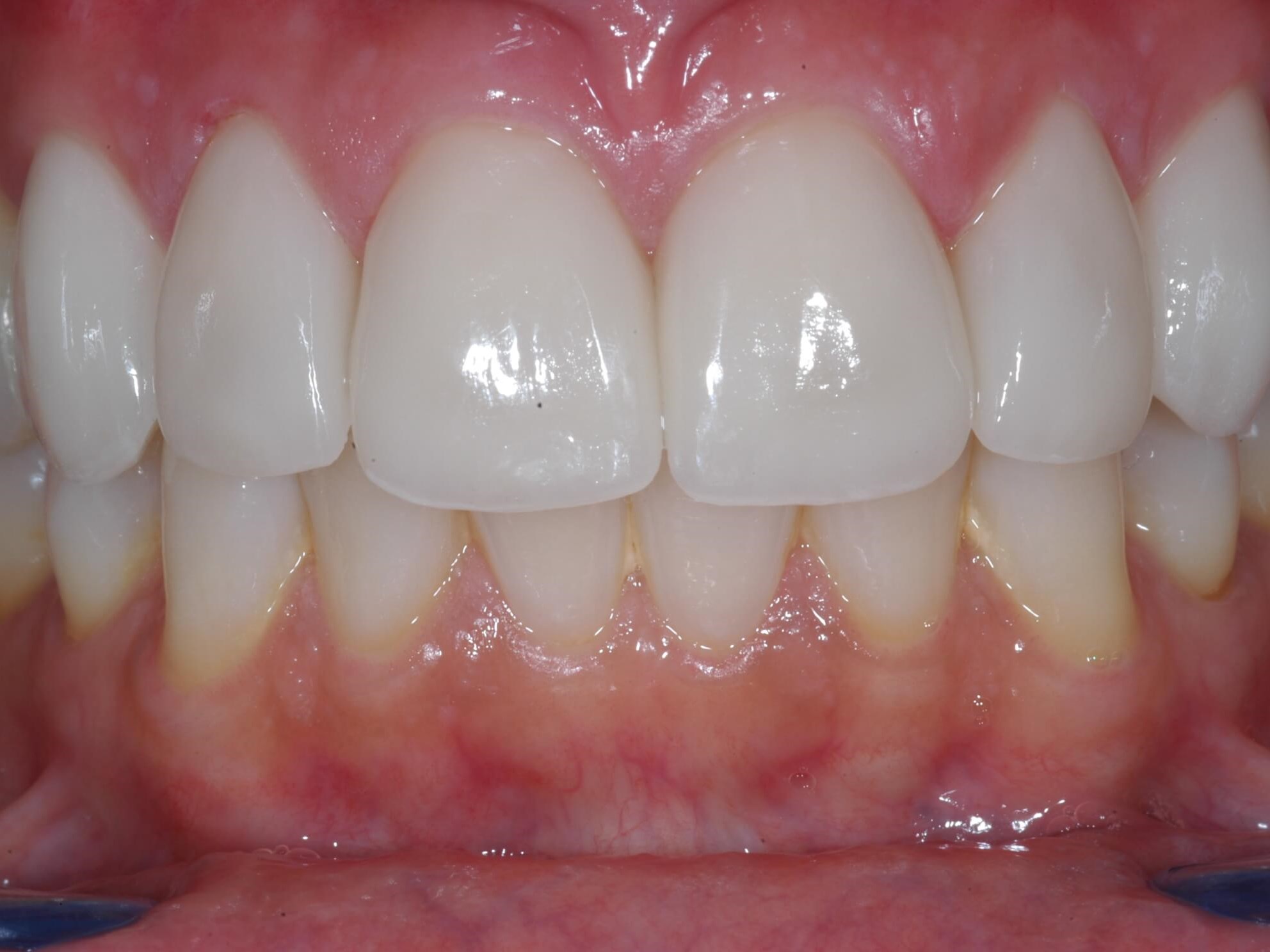 Retracted smile After
