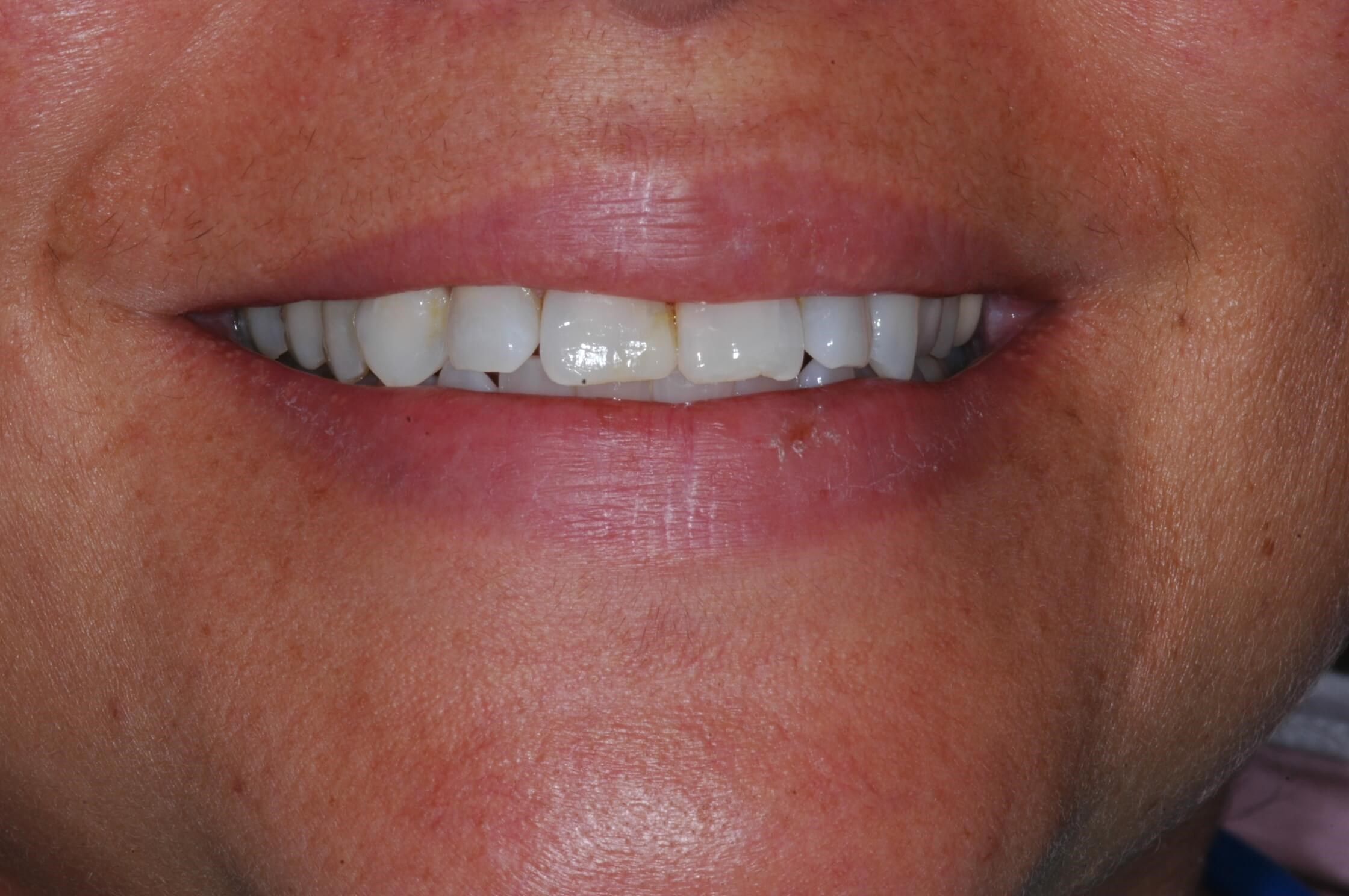 Full Smile Before