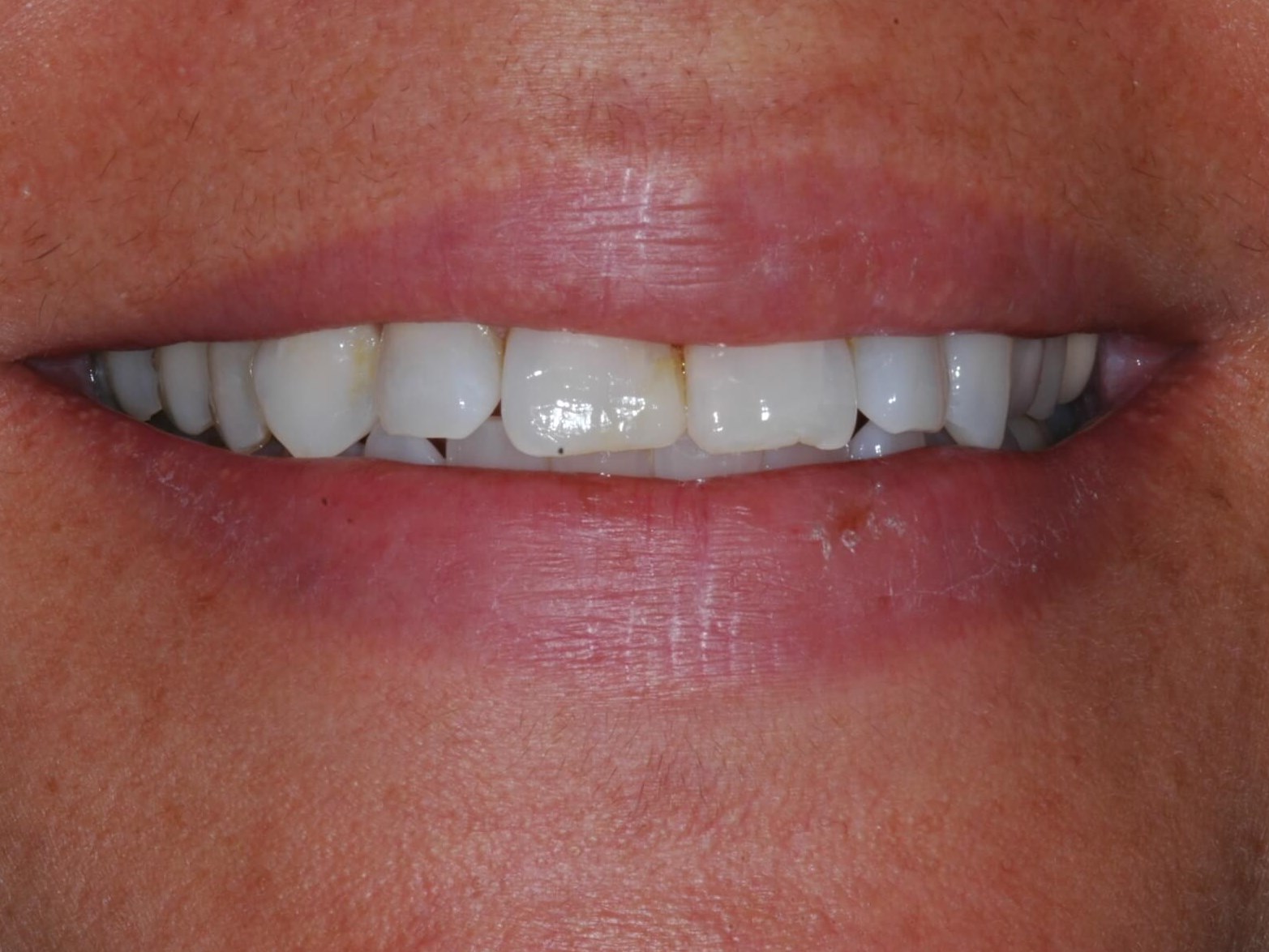 Full Smile Before