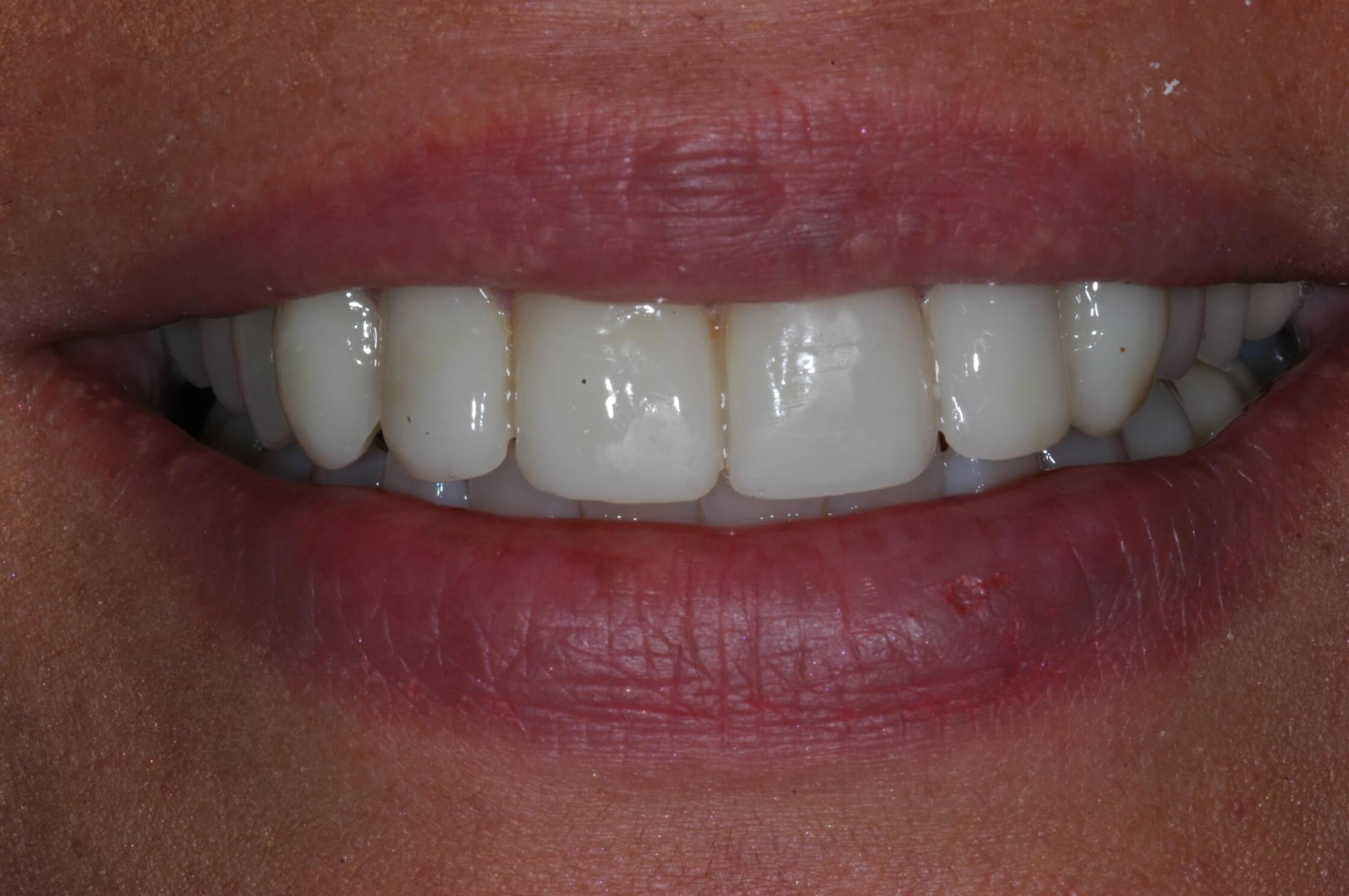 Full Smile After