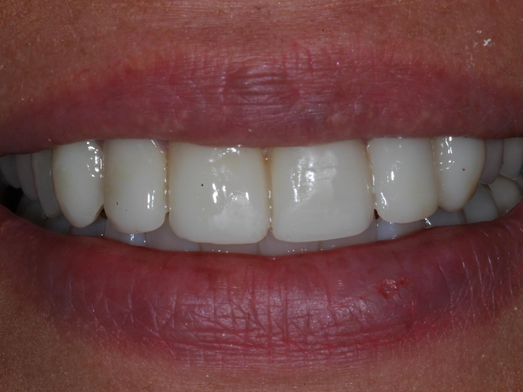 Full Smile After
