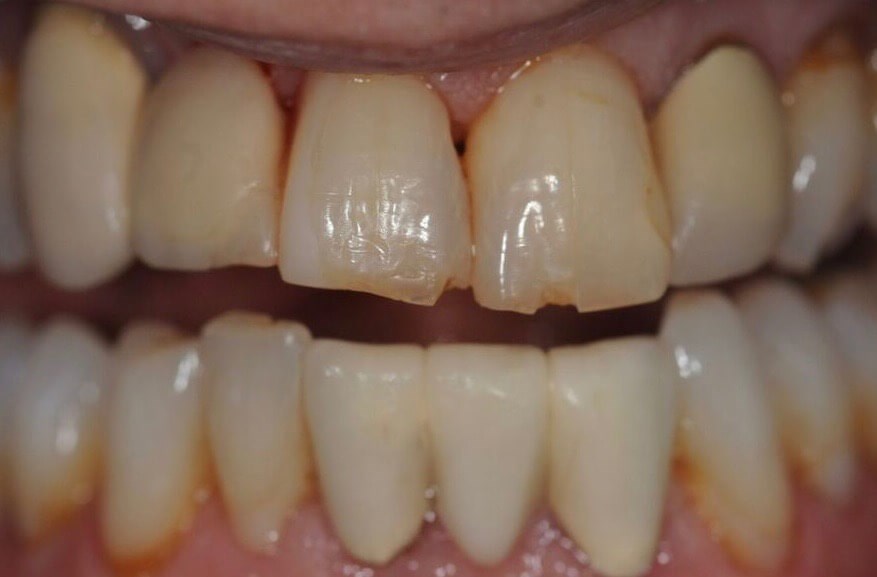 Cosmetic Dental Bonding Before