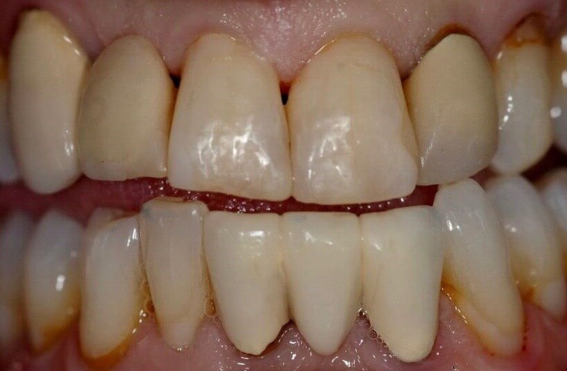 Cosmetic Dental Bonding After