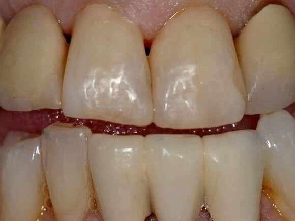 Cosmetic Dental Bonding After
