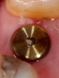 Single Tooth Dental Implant Before
