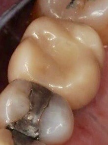 Single Tooth Dental Implant After