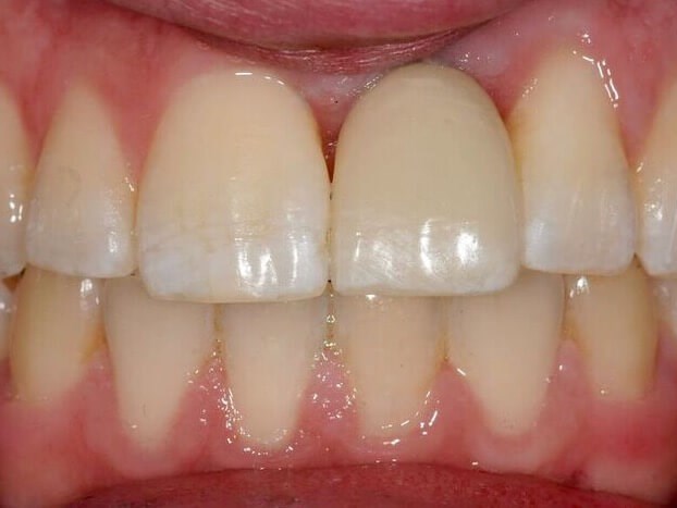 A Conservative Way To Replace A Missing Front Tooth