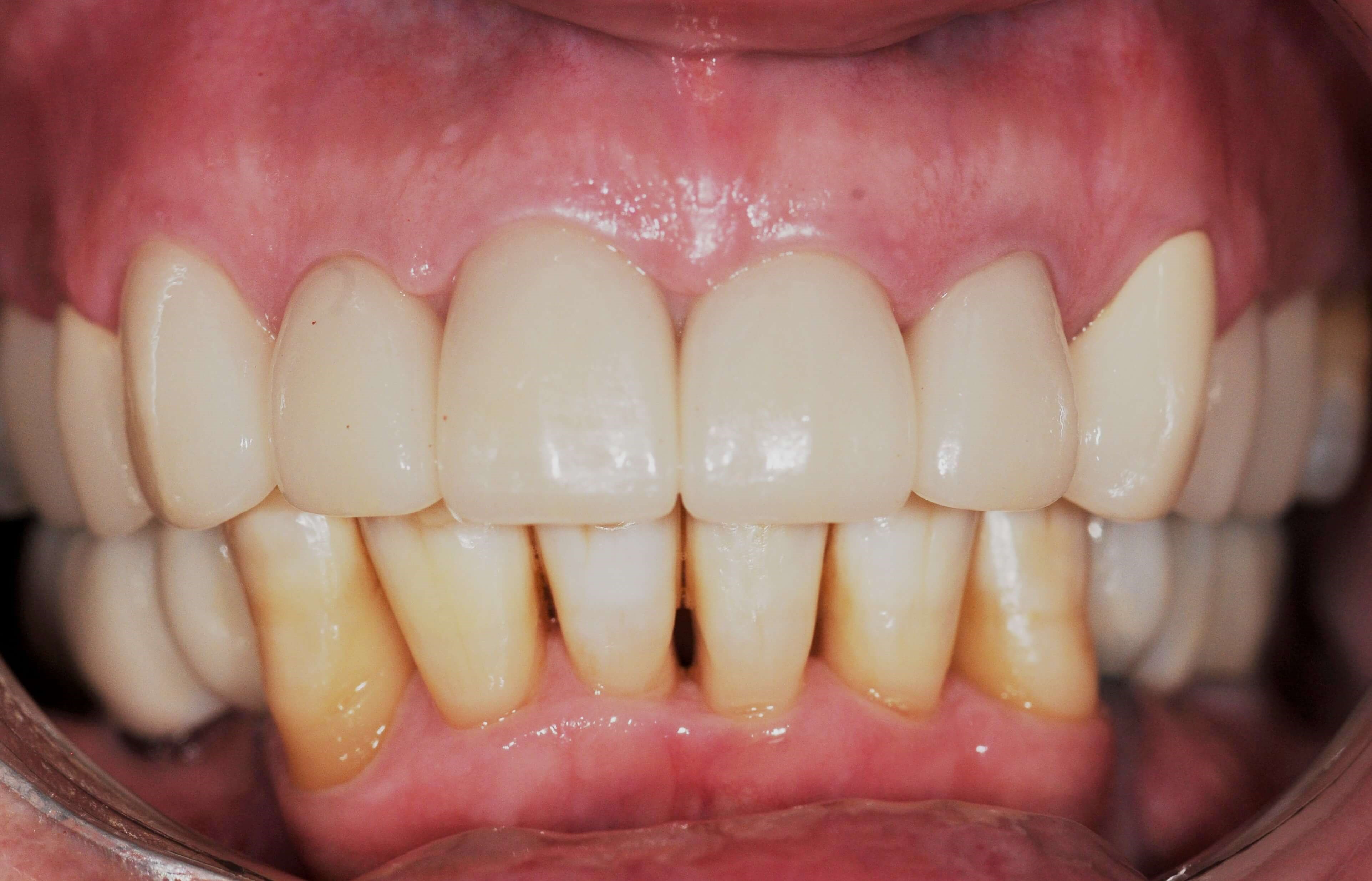 Back to a Happy Smile! After