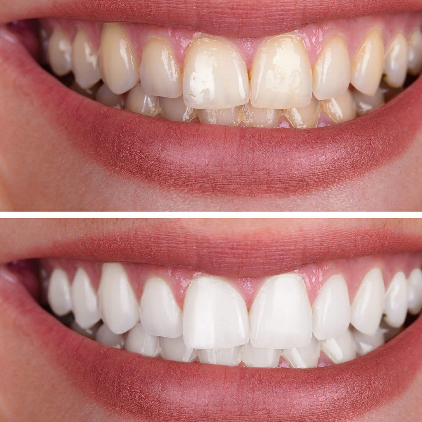 results of professional teeth 