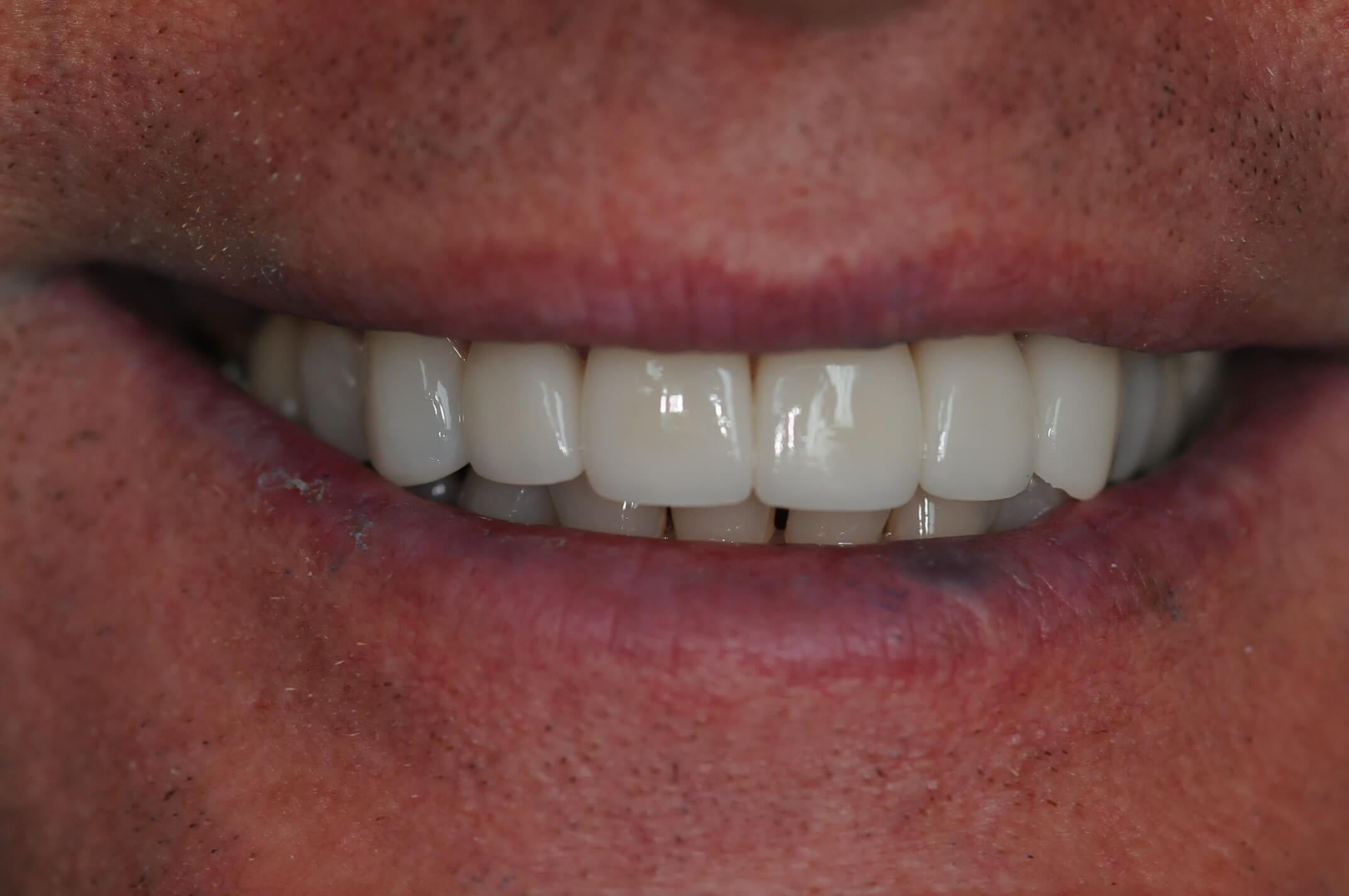 Full smile After