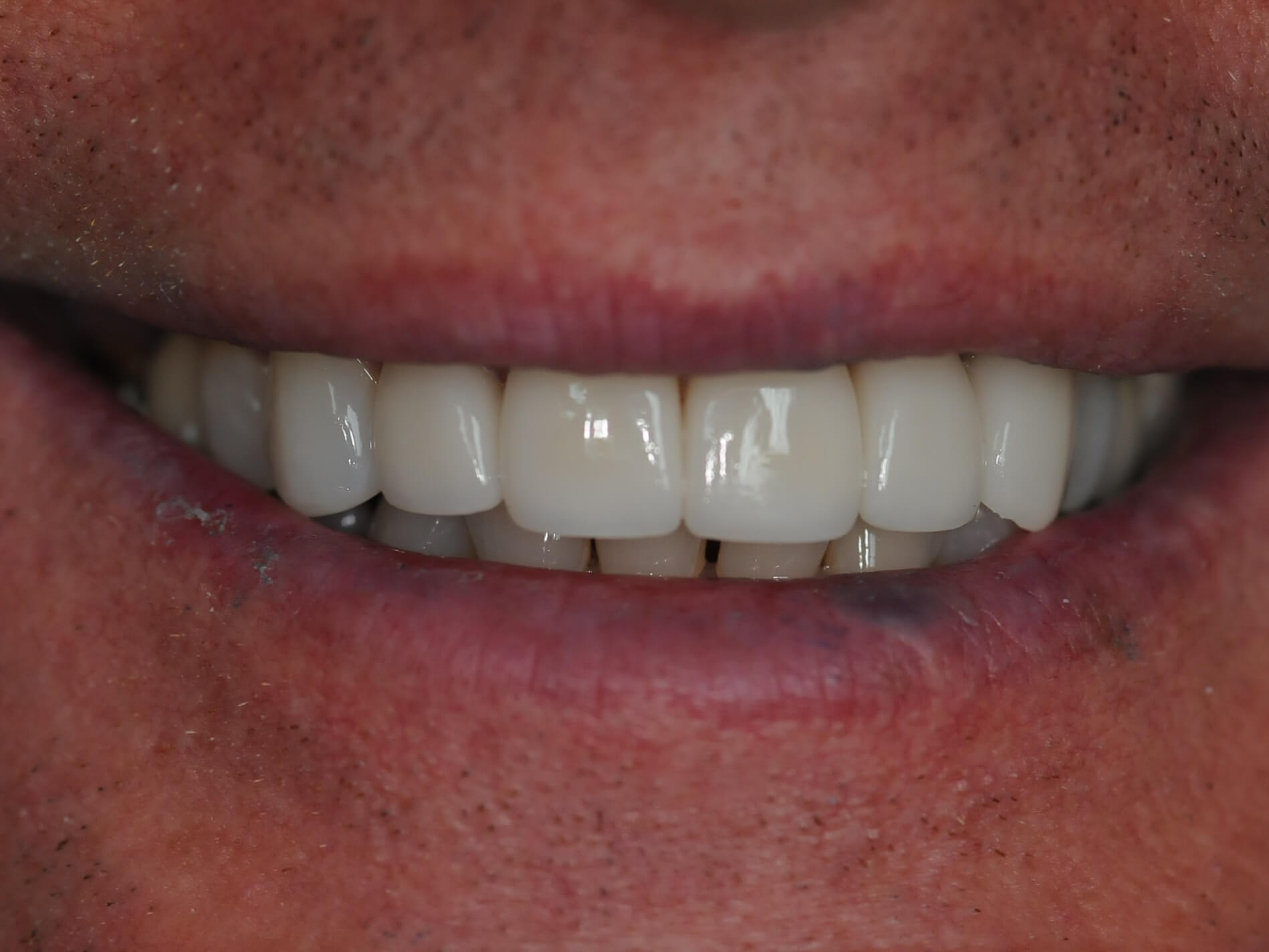 Full smile After