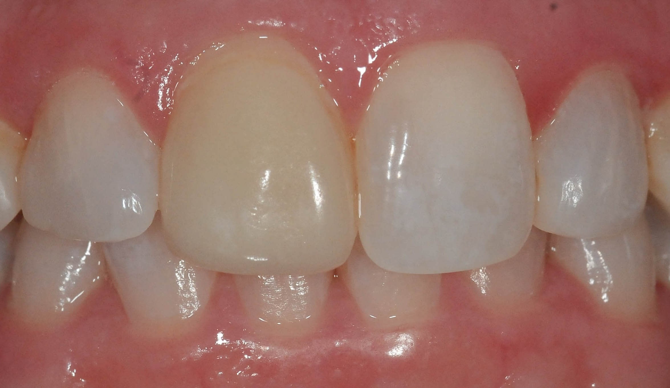 Retracted Smile Before