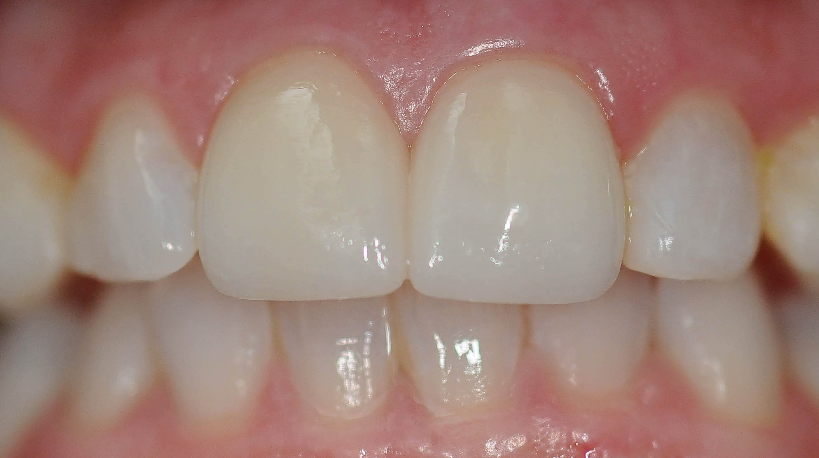 Retracted Smile After