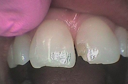 Veneer Repair Results, Plano Broken Veneer