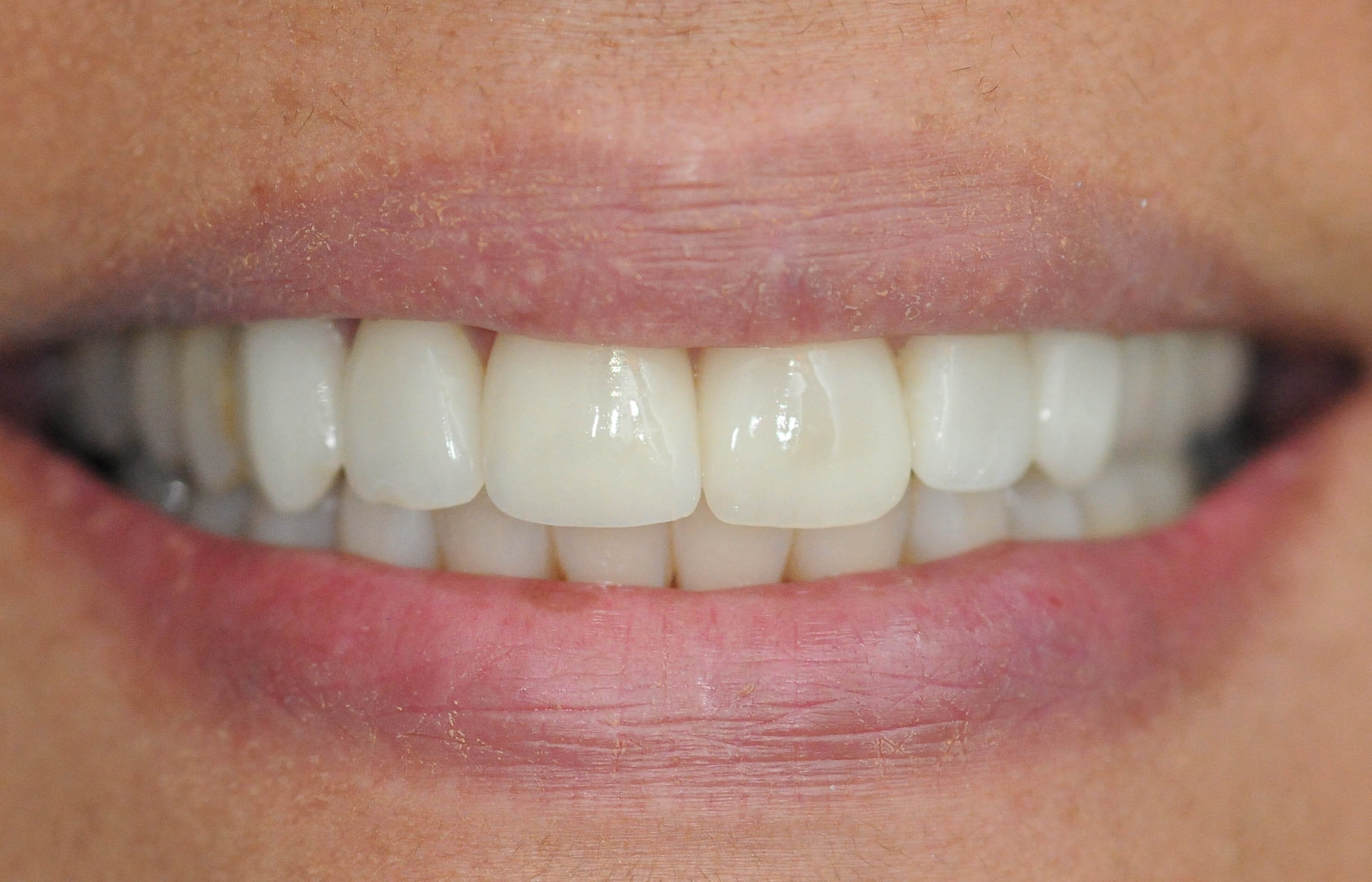 Veneer Repair Results, Plano After Repair