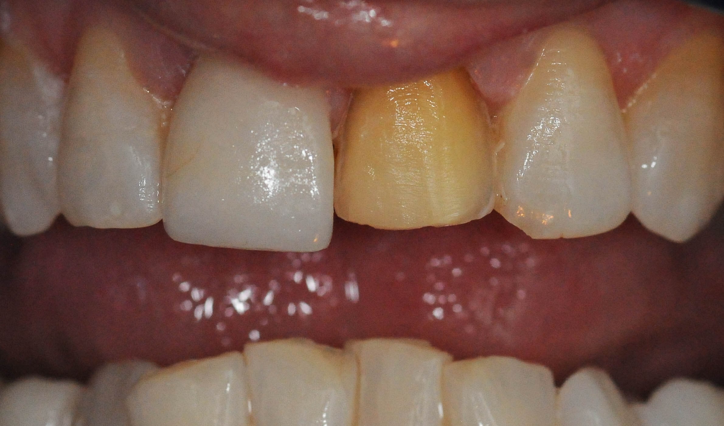 Replacing broken/old Veneers Before