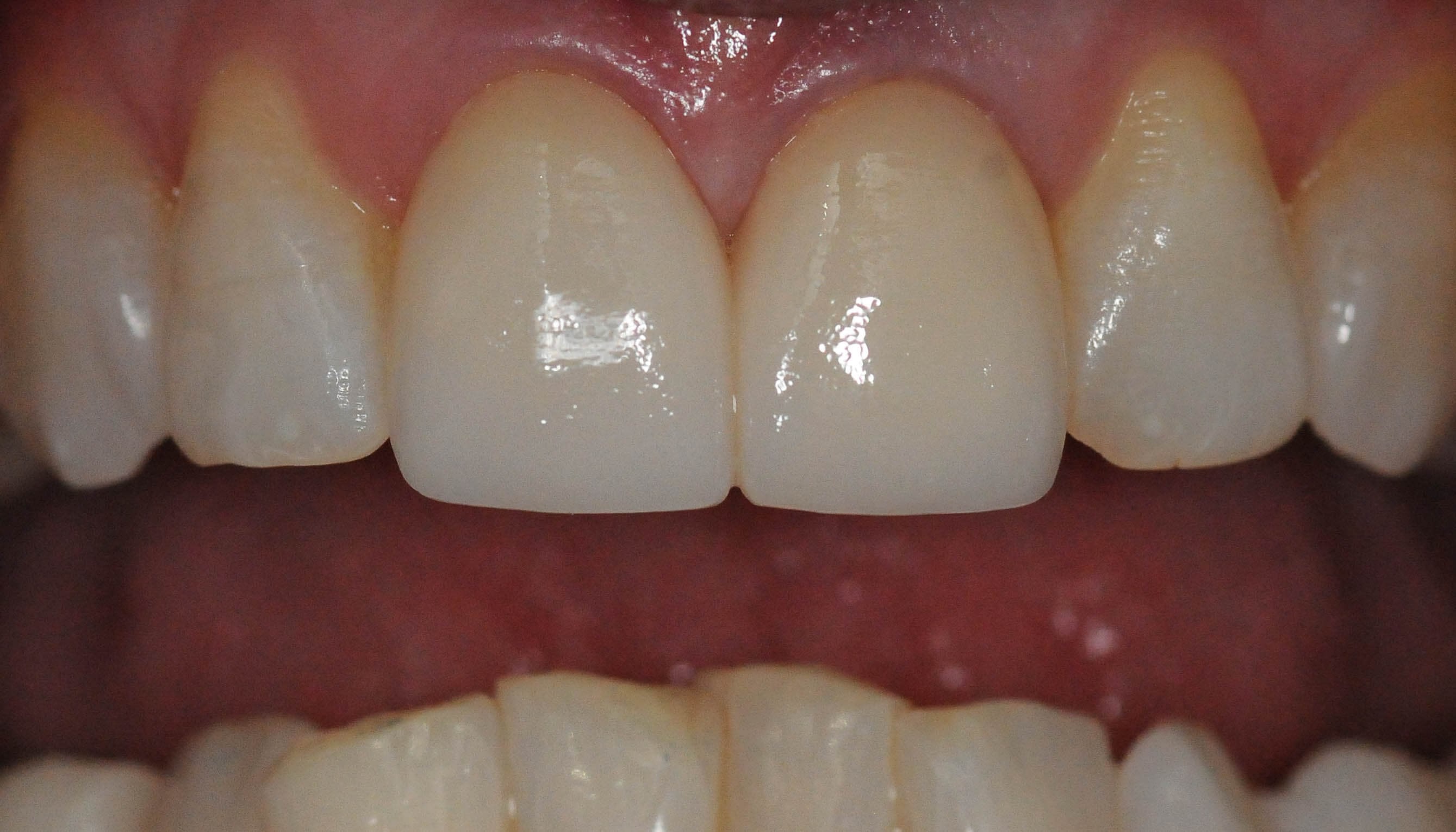 Replacing broken/old Veneers After