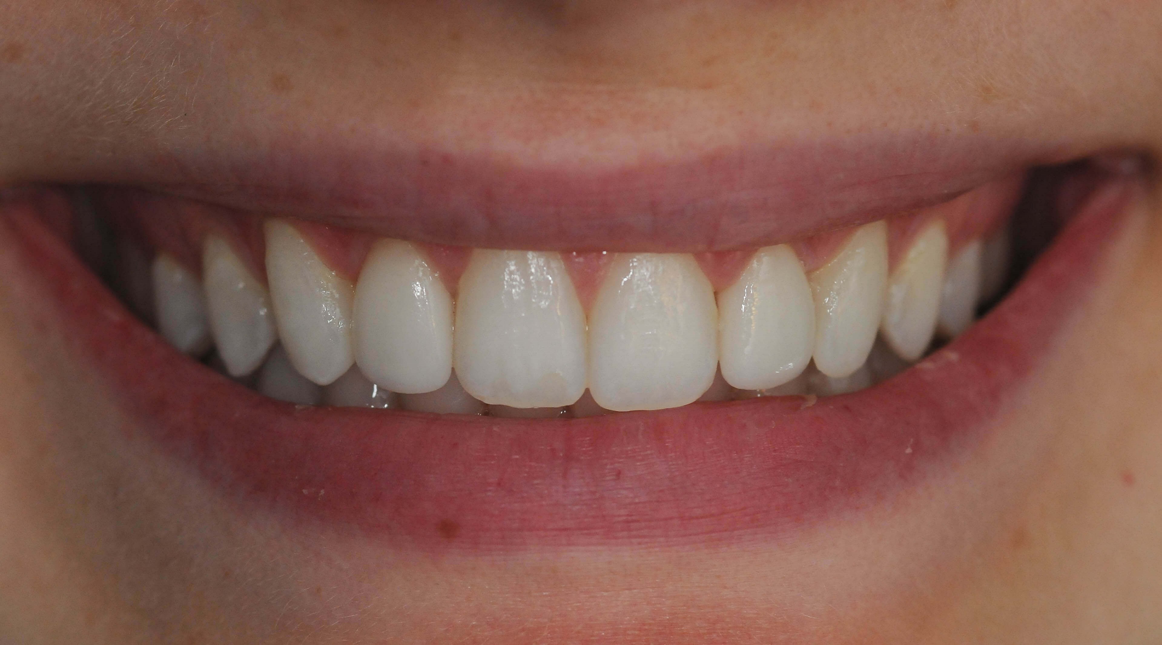 Smile Makeover Results After