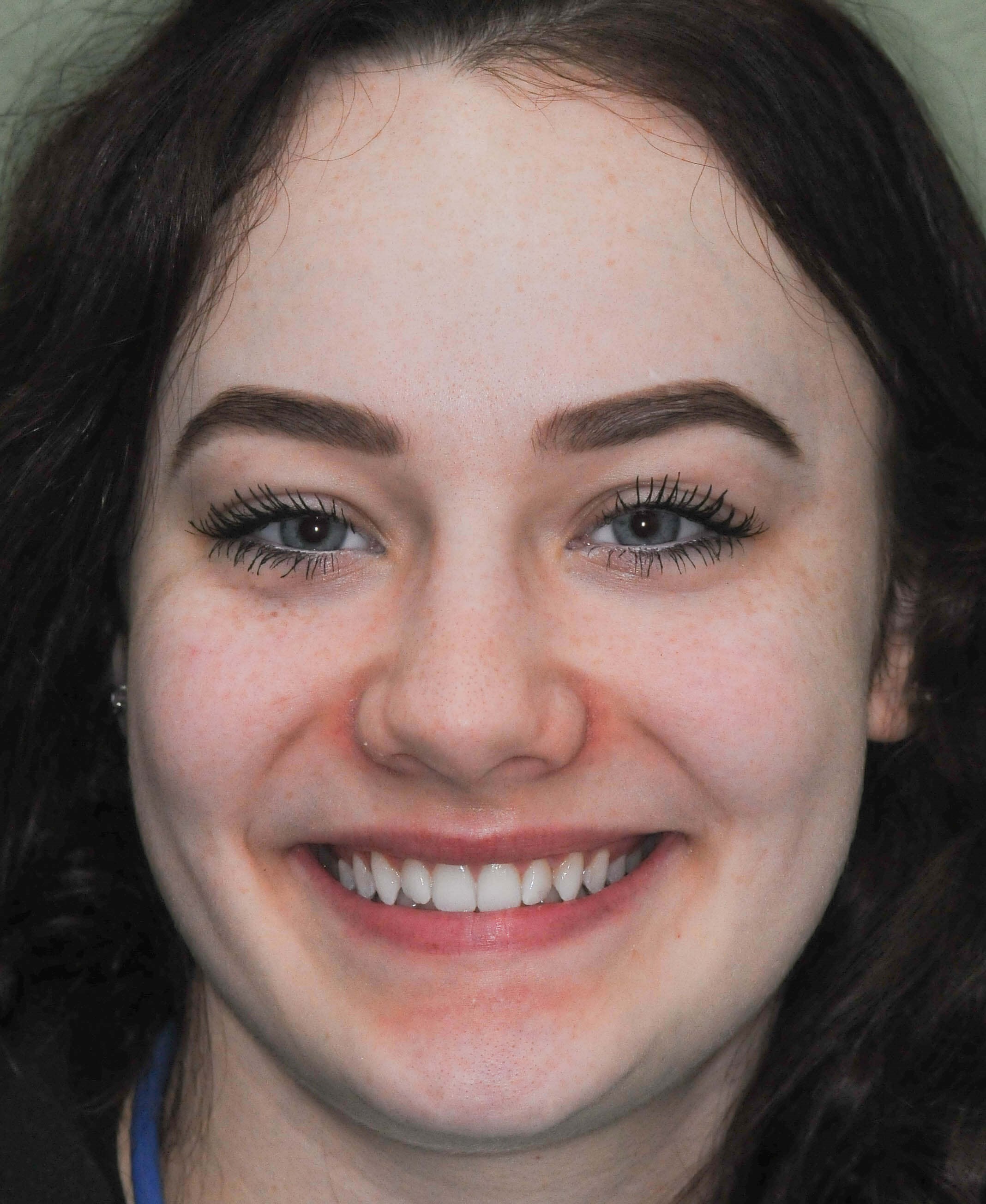 Smile Makeover Results Before