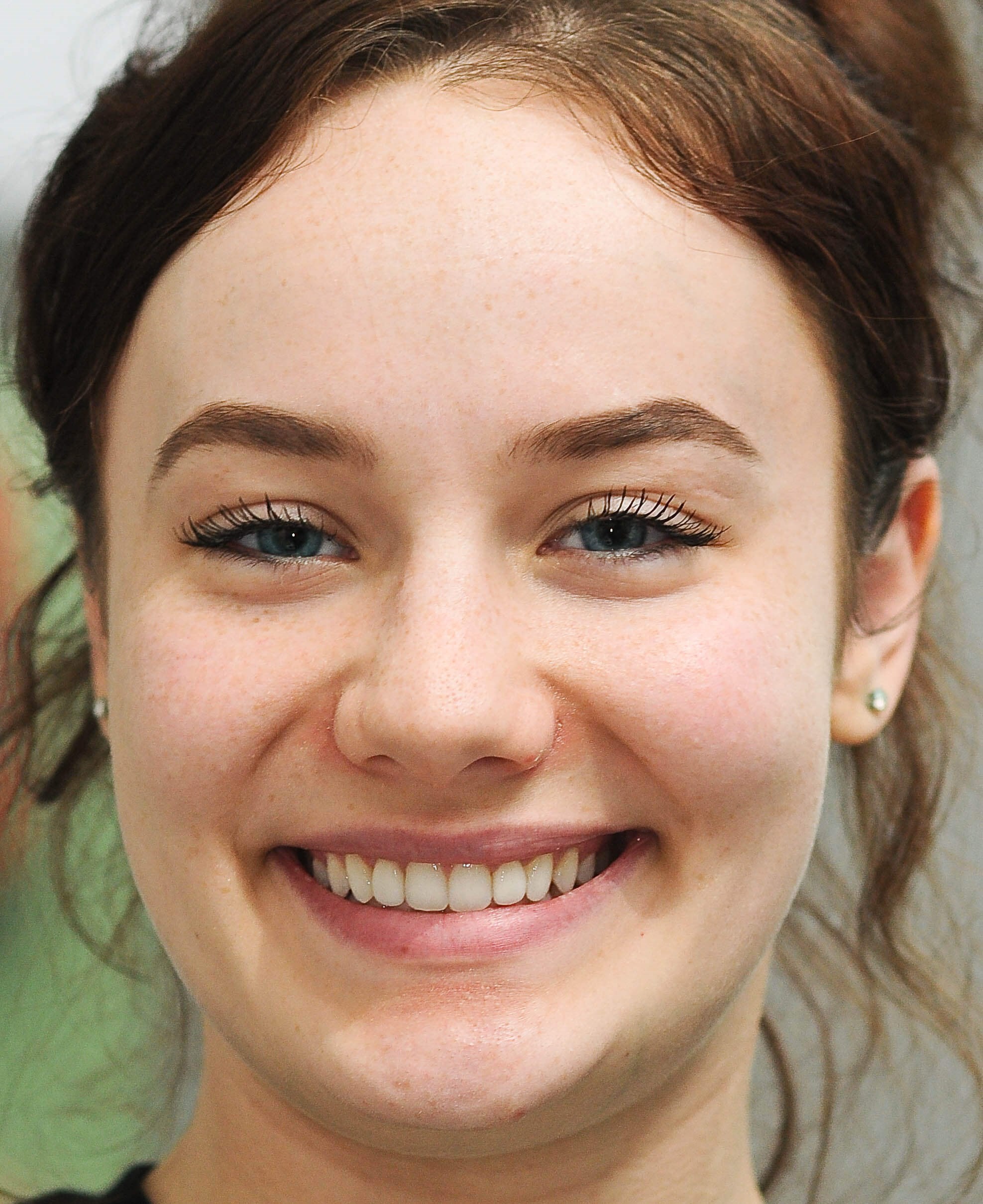 Smile Makeover Results After
