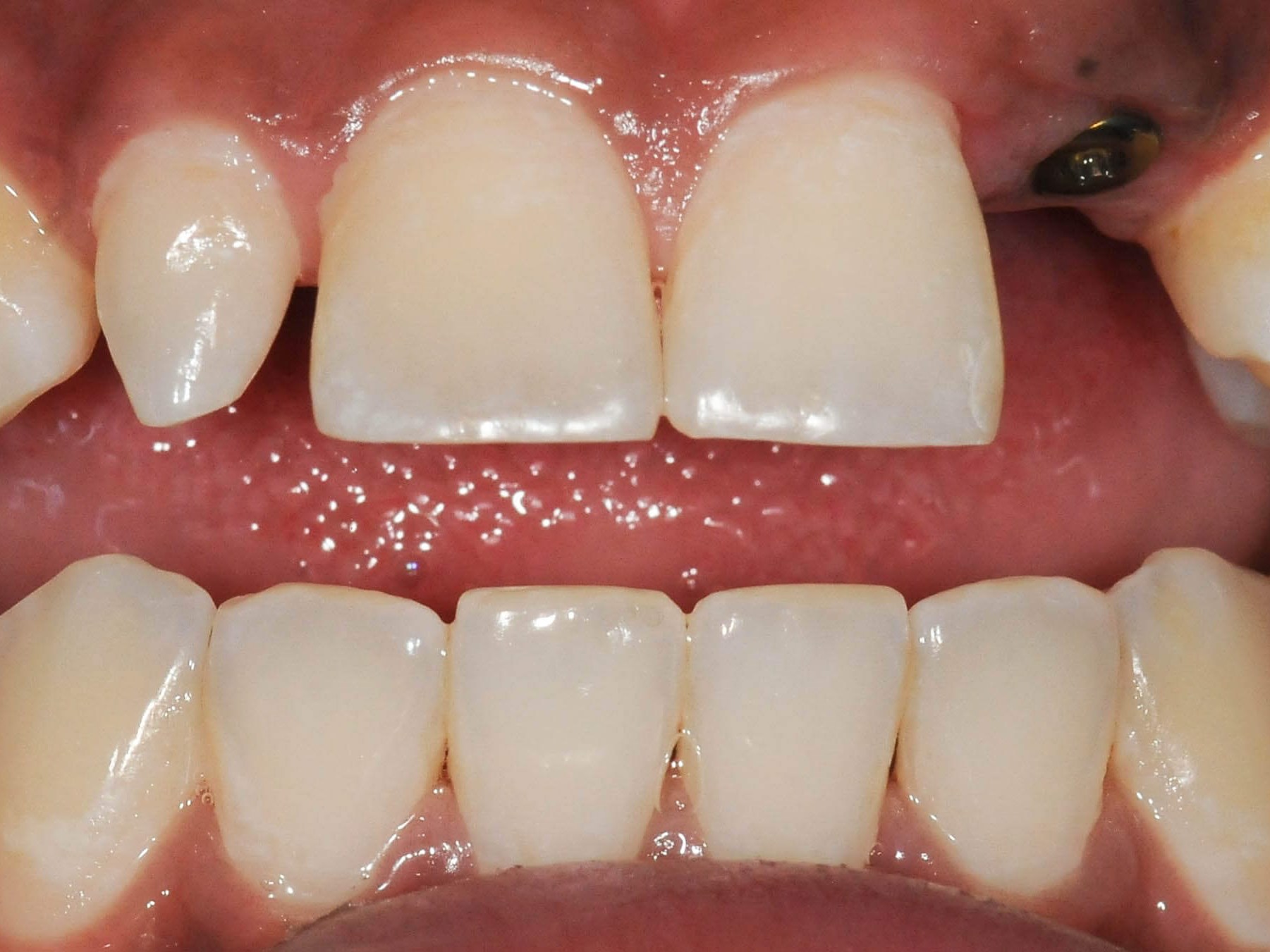 Smile Makeover Plano, Tx Before