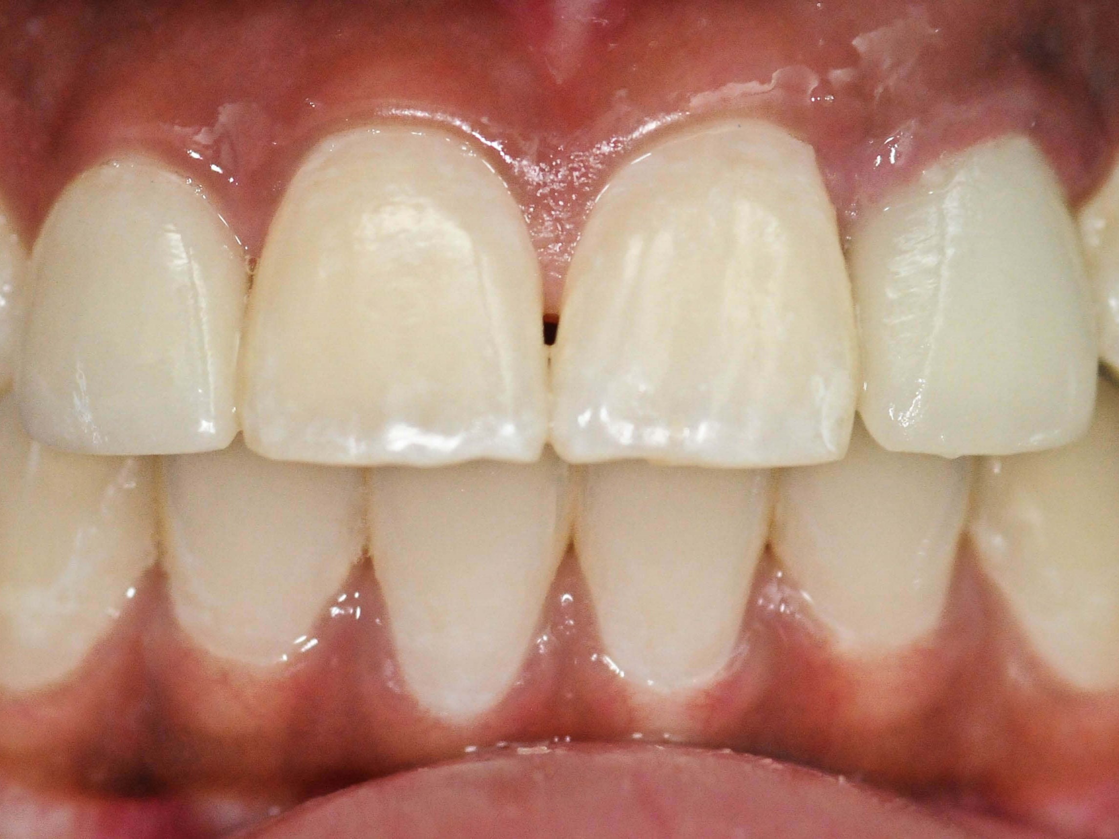 Smile Makeover Plano, Tx After