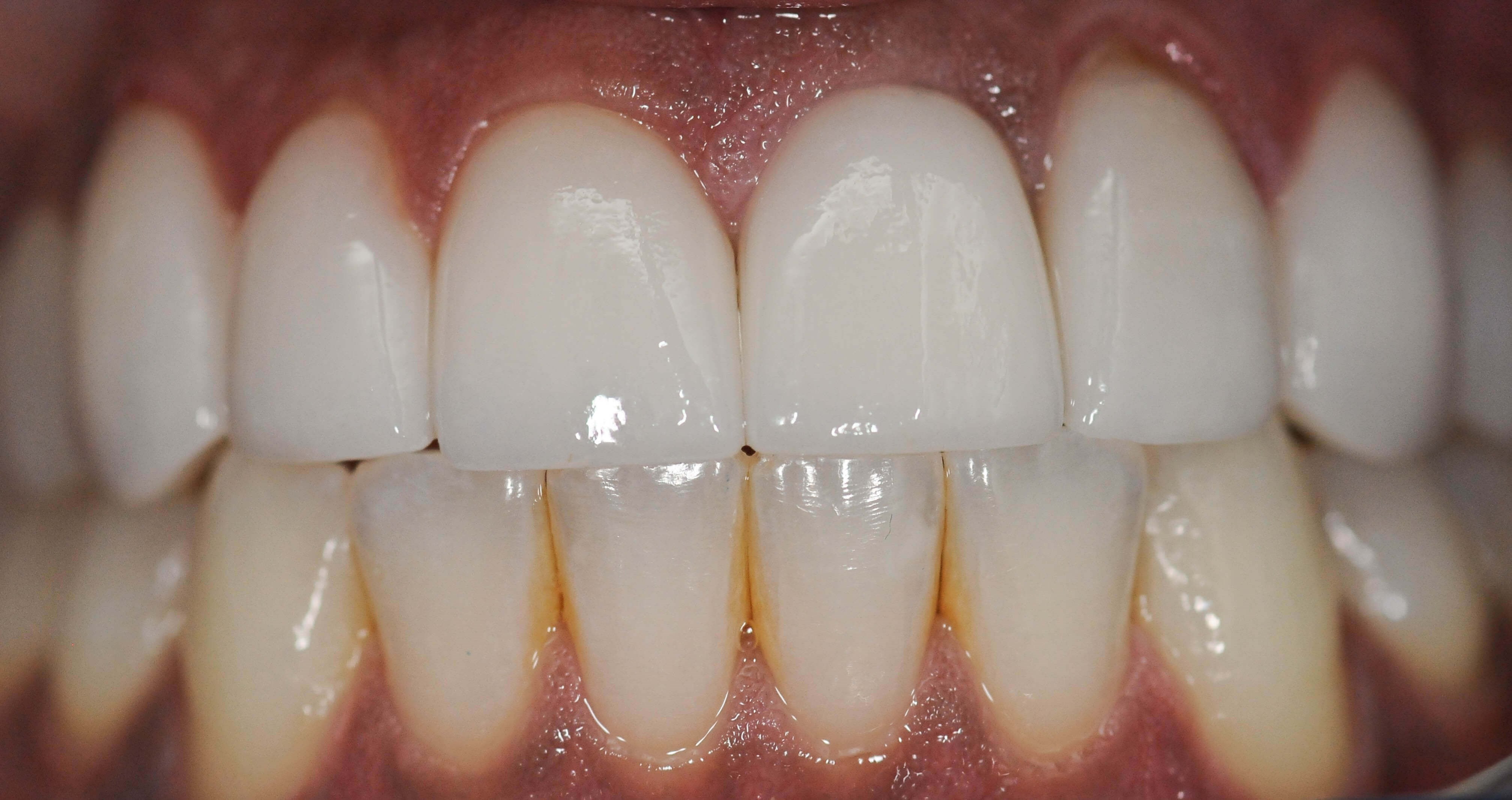 Veneers Create Gorgeous Smile After