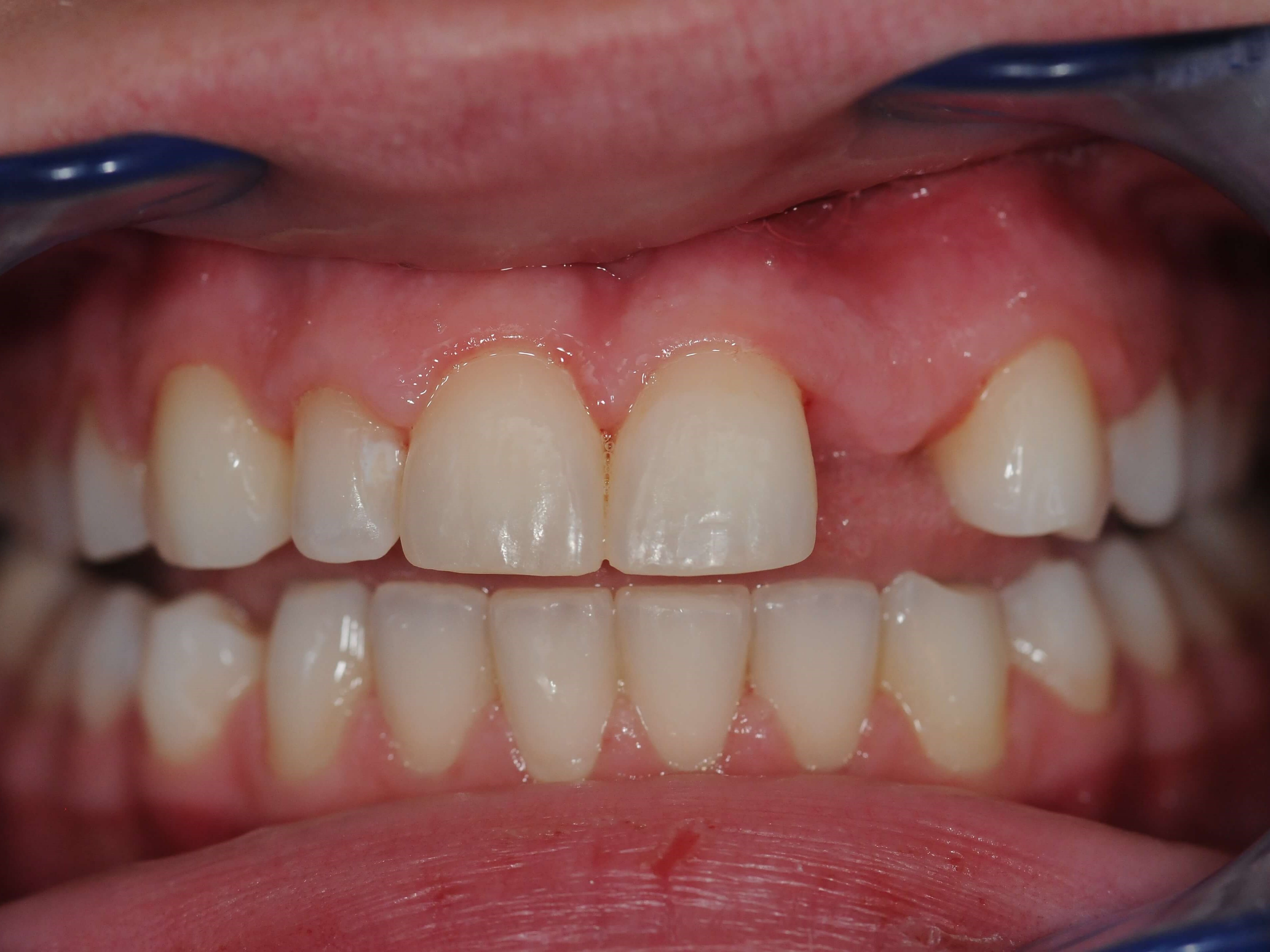 New Symmetrical Smile Before