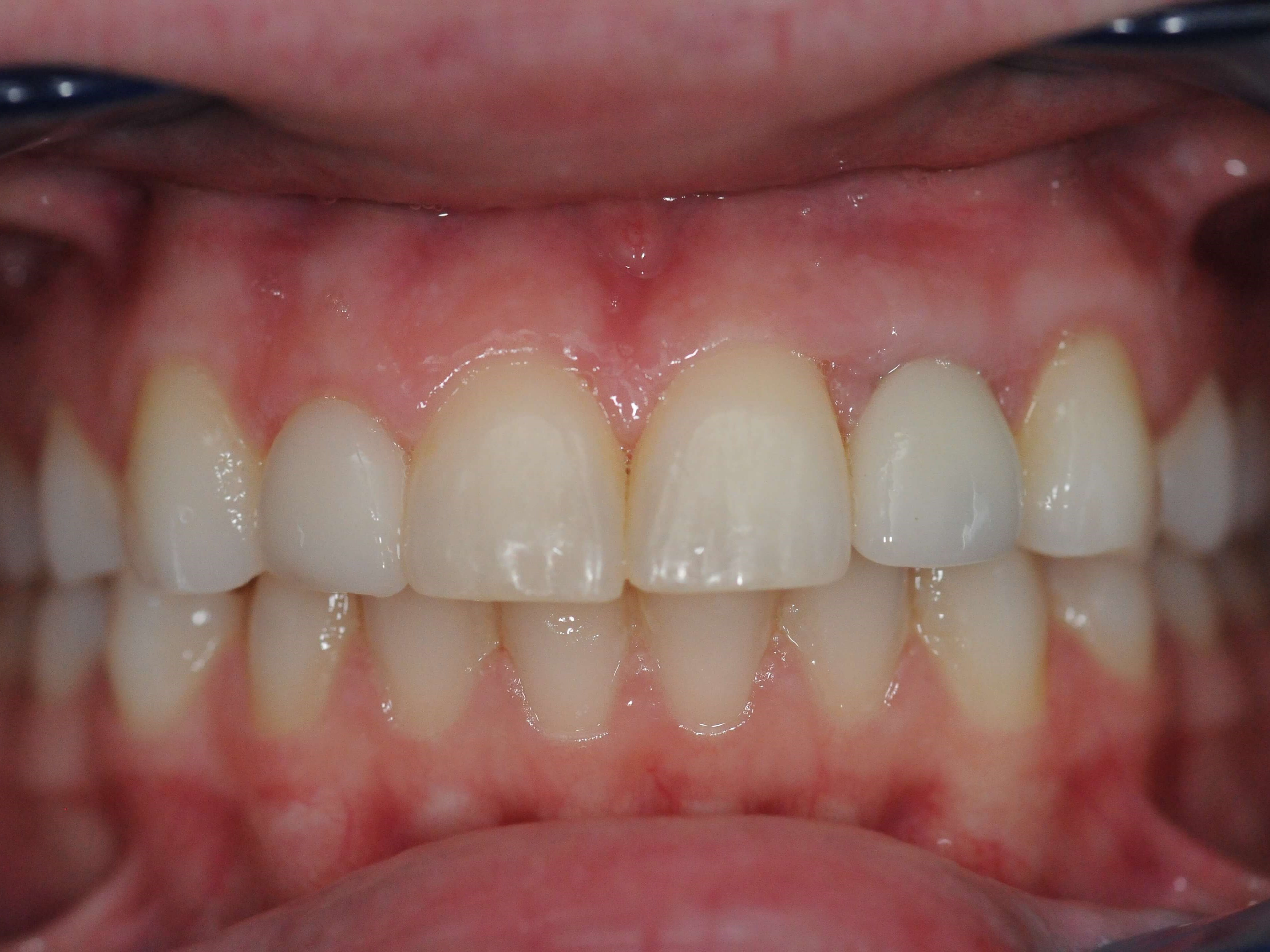 New Symmetrical Smile After