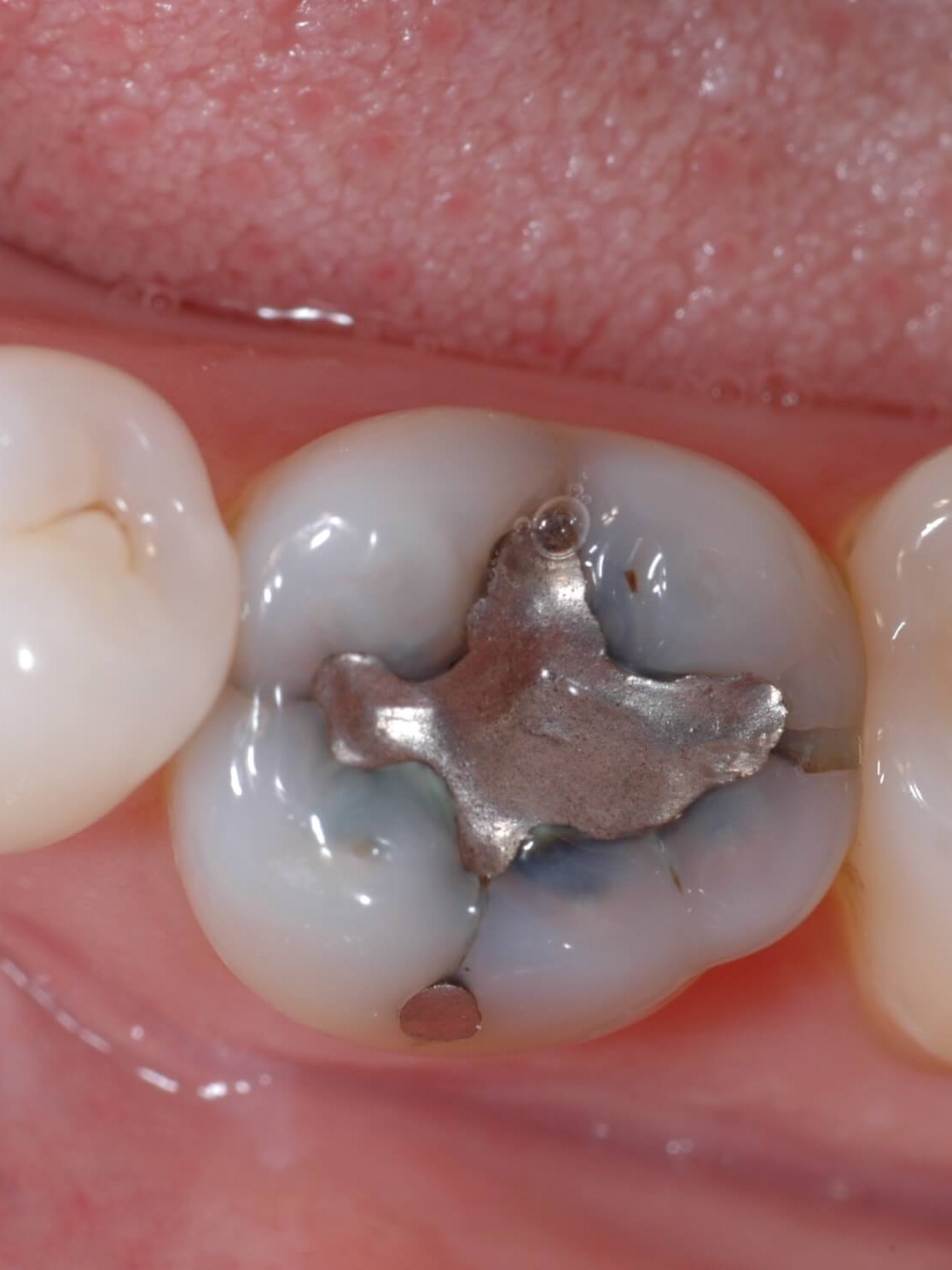 Dental Technology Is Amazing! Before