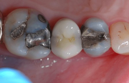 Removing Old Silver Fillings Before