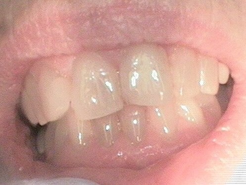Teeth Whitening Results Before