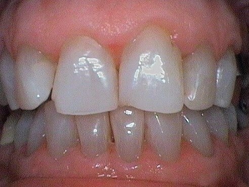 Teeth Whitening Results After