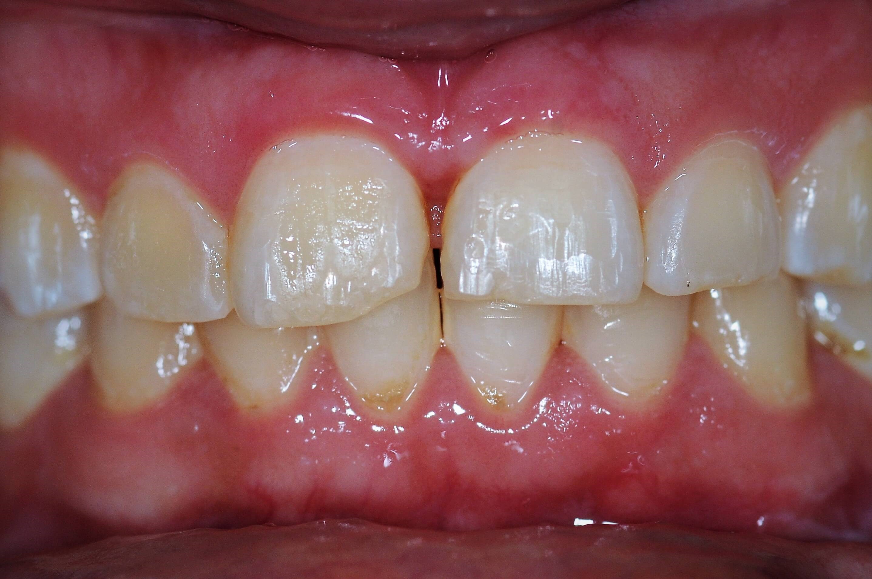 Cosmetic Dentistry Results Before
