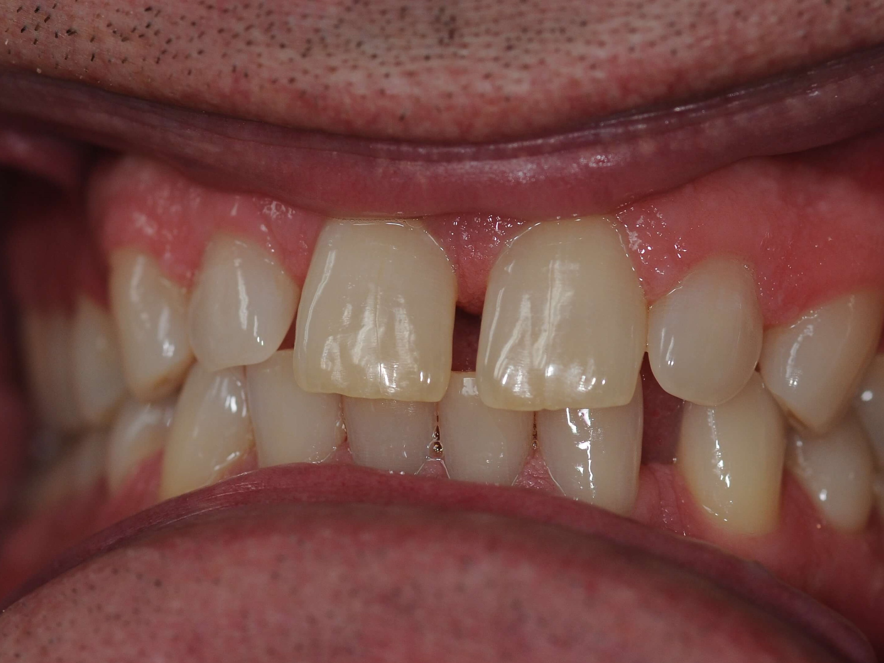Dental Crowns Close The Gaps Before