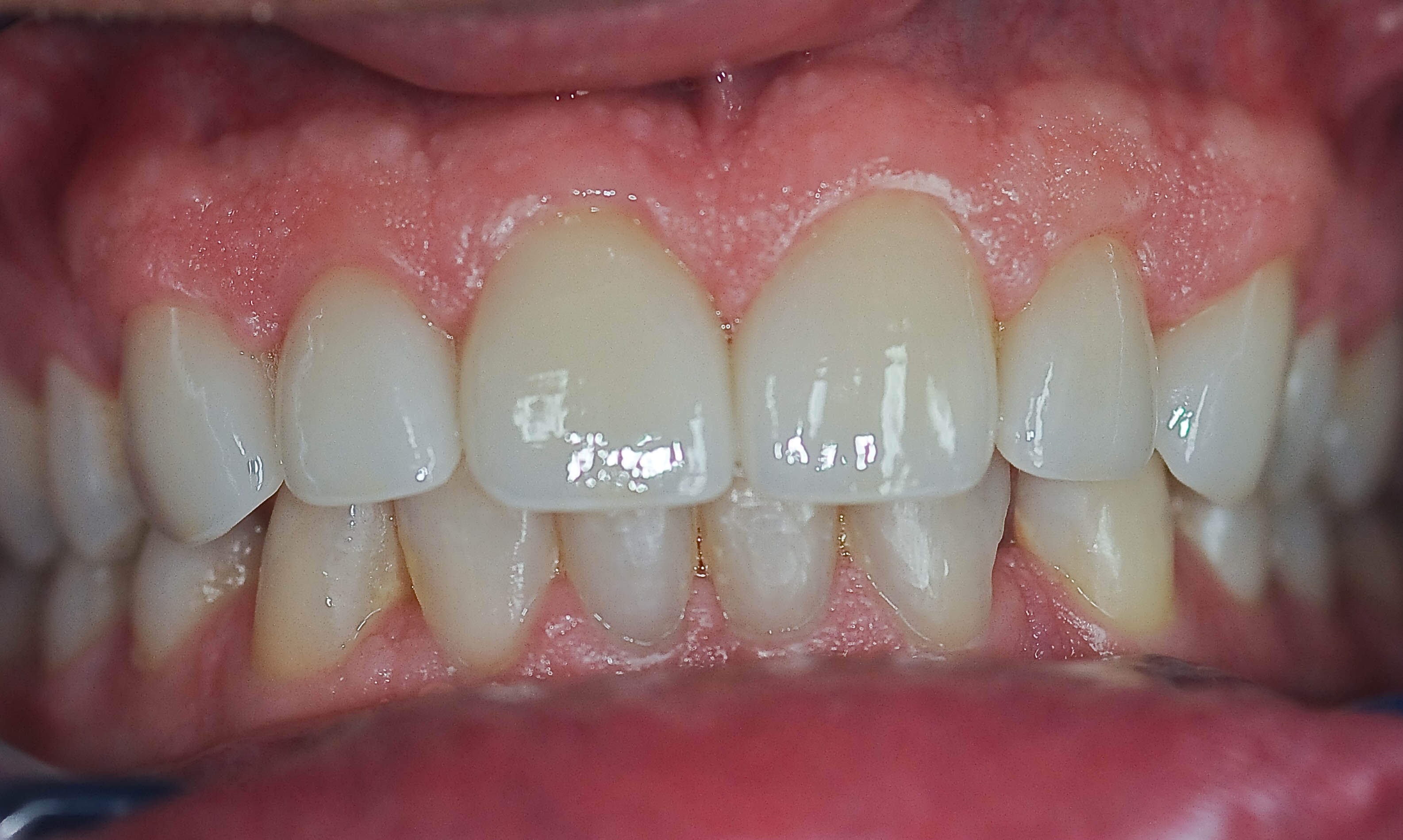 Before and After Smile Makeover & Dental Crowns & Teeth Whitening Photos