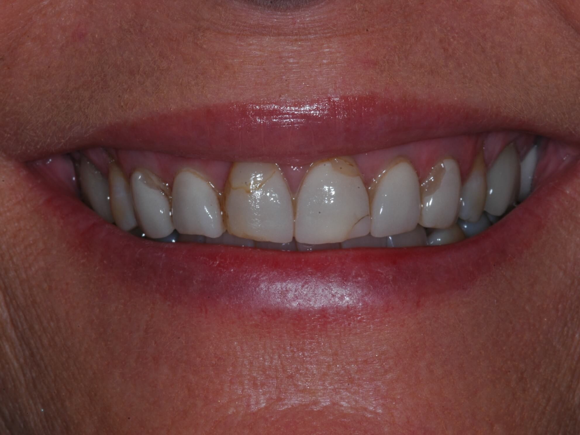 Full Coverage Crowns Before