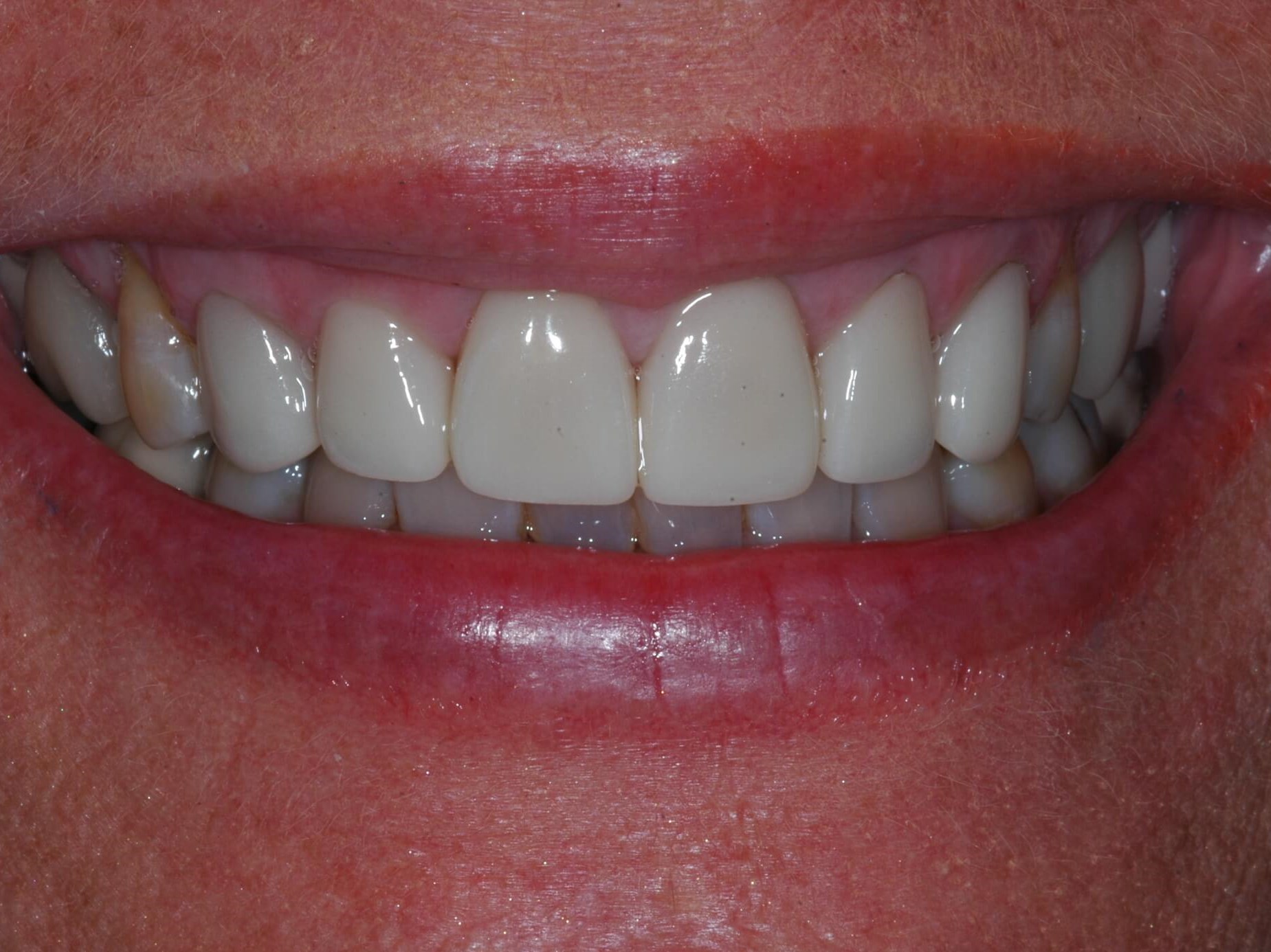 Full Coverage Crowns After