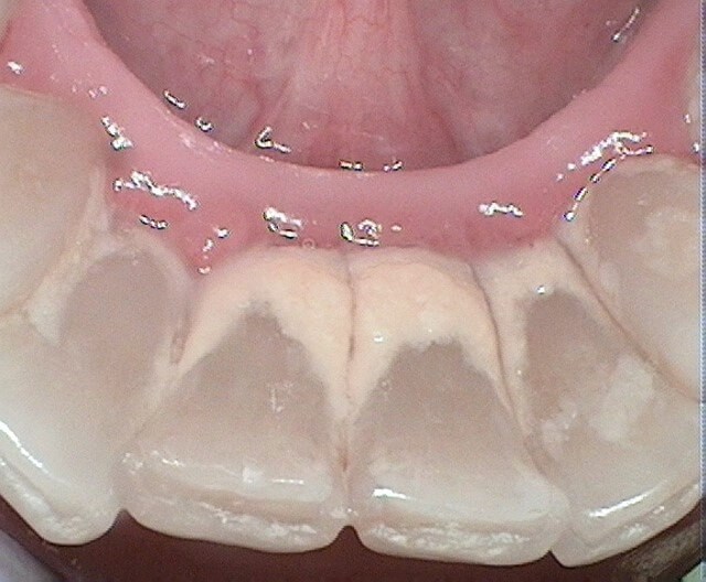 Periodontal Treatment Before