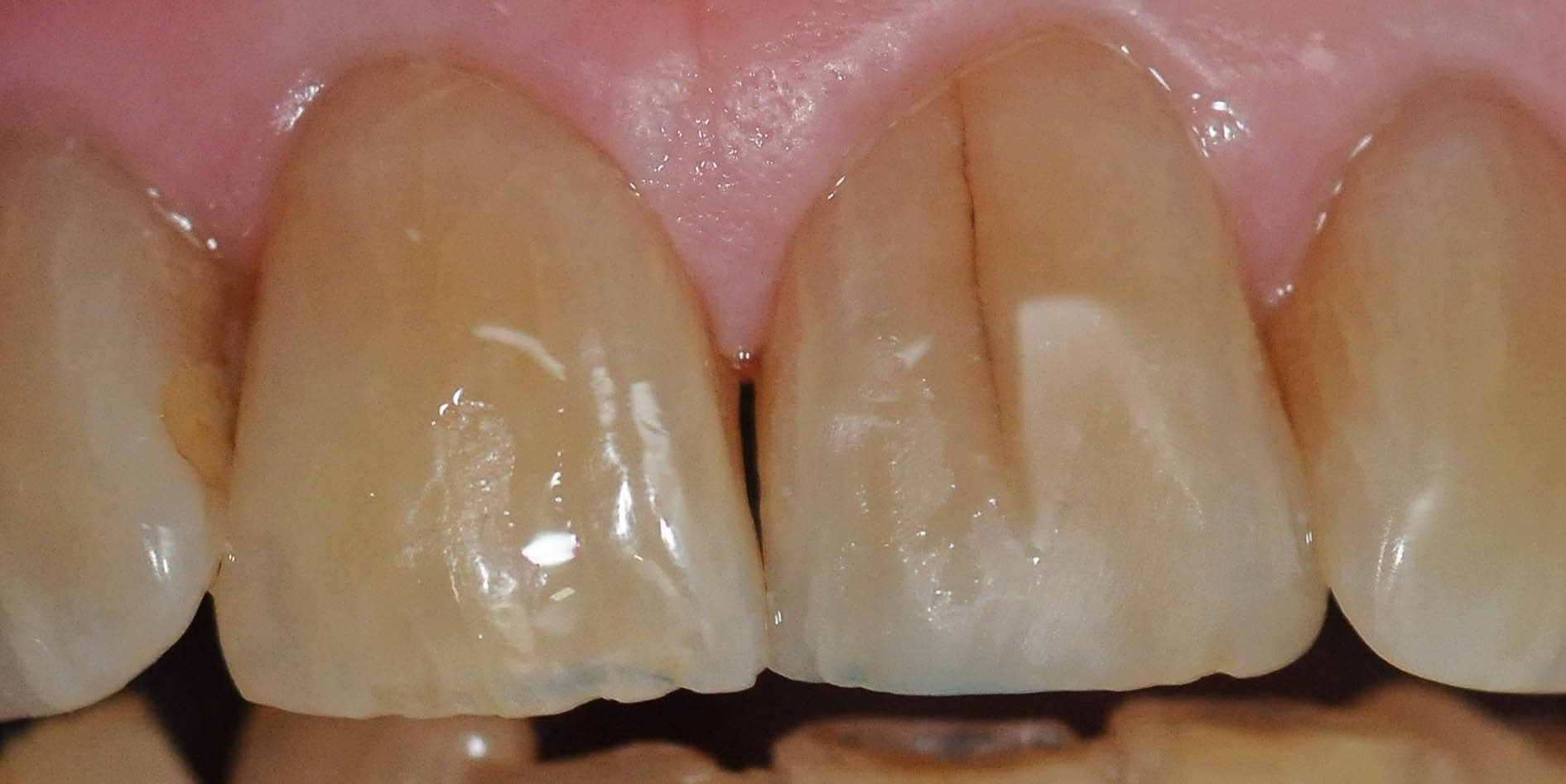 Emergency Repair Front Tooth After