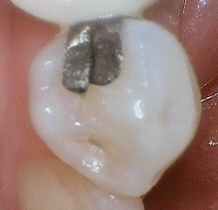 Replacing Broken Amalgam Before