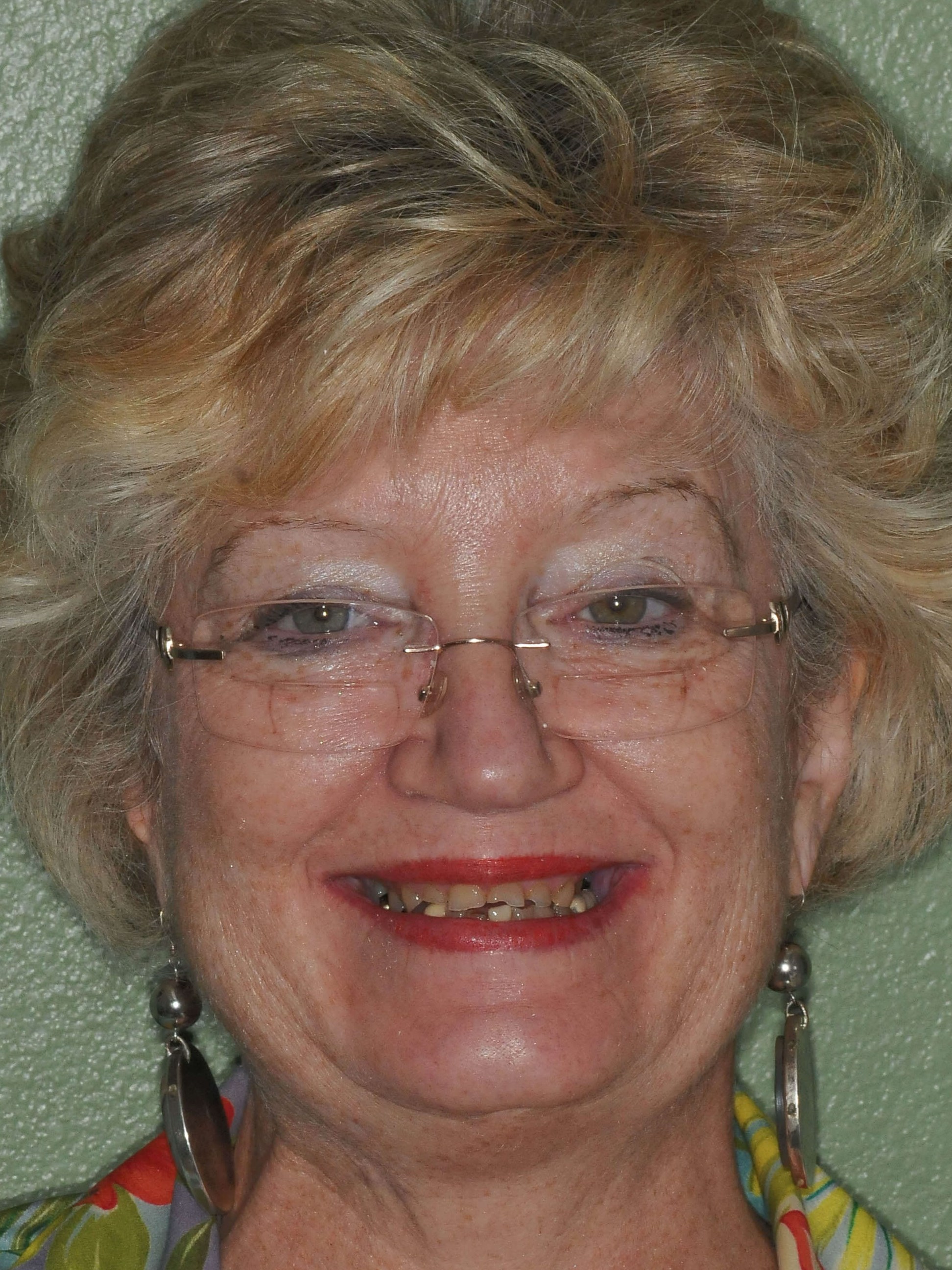 Implant Supported Dentures Before
