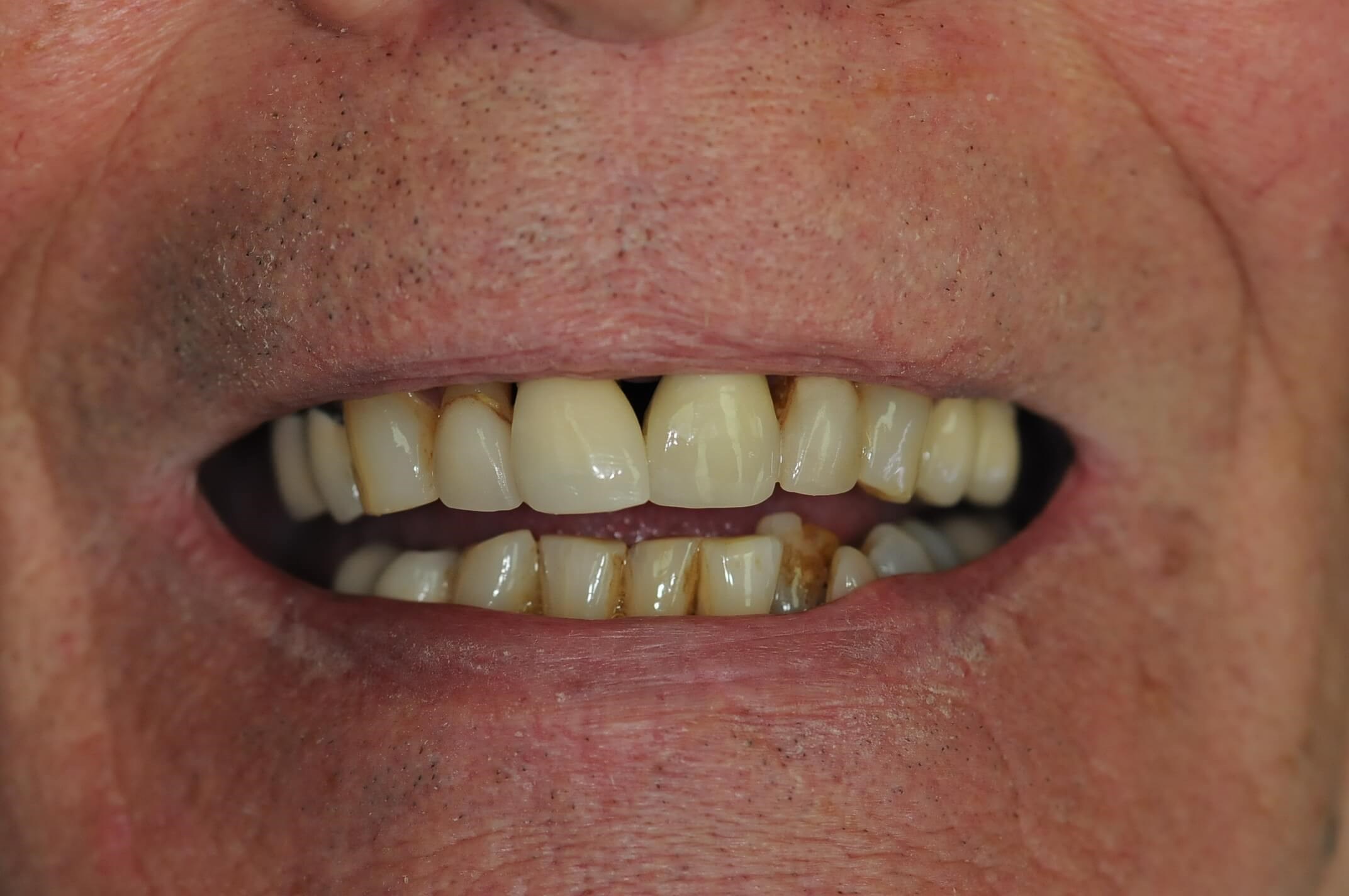 Brand New Smile Before