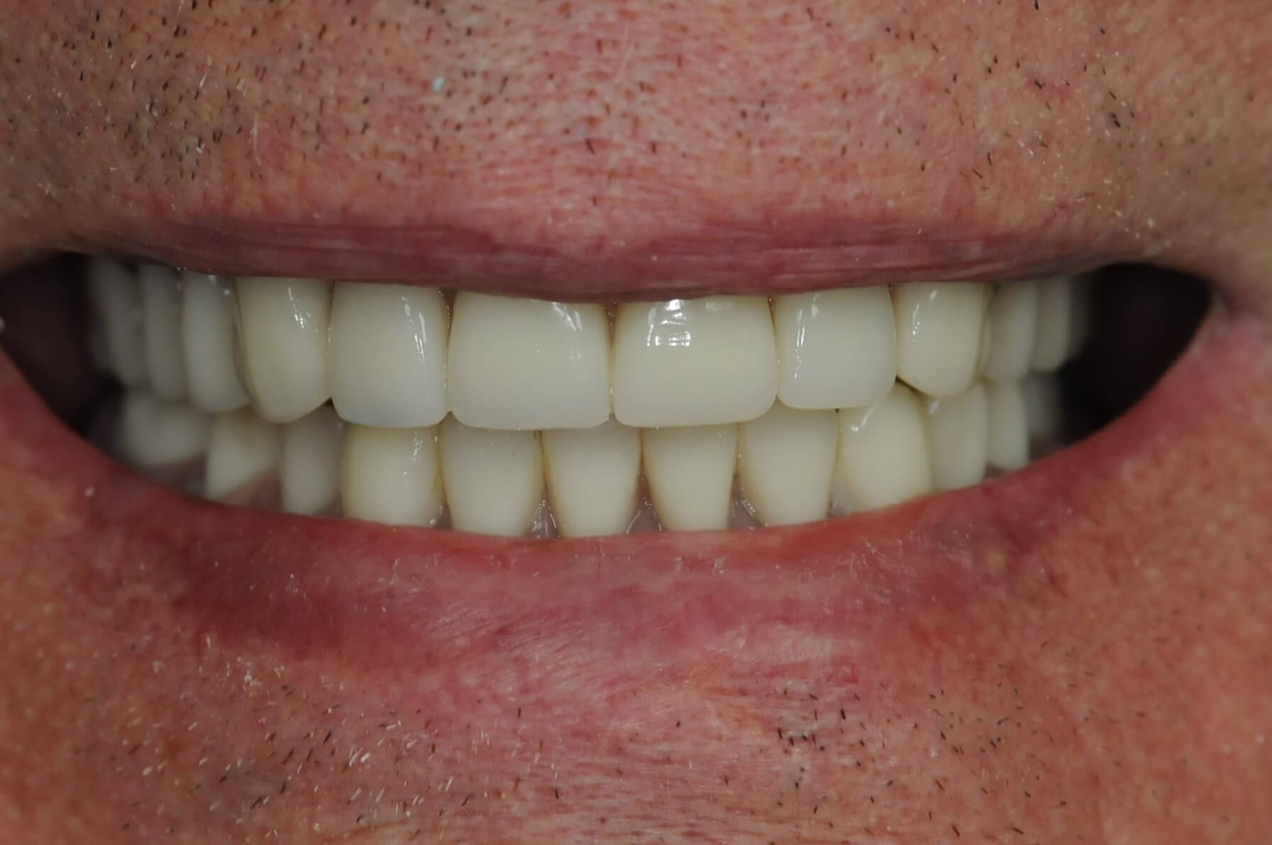 Brand New Smile After