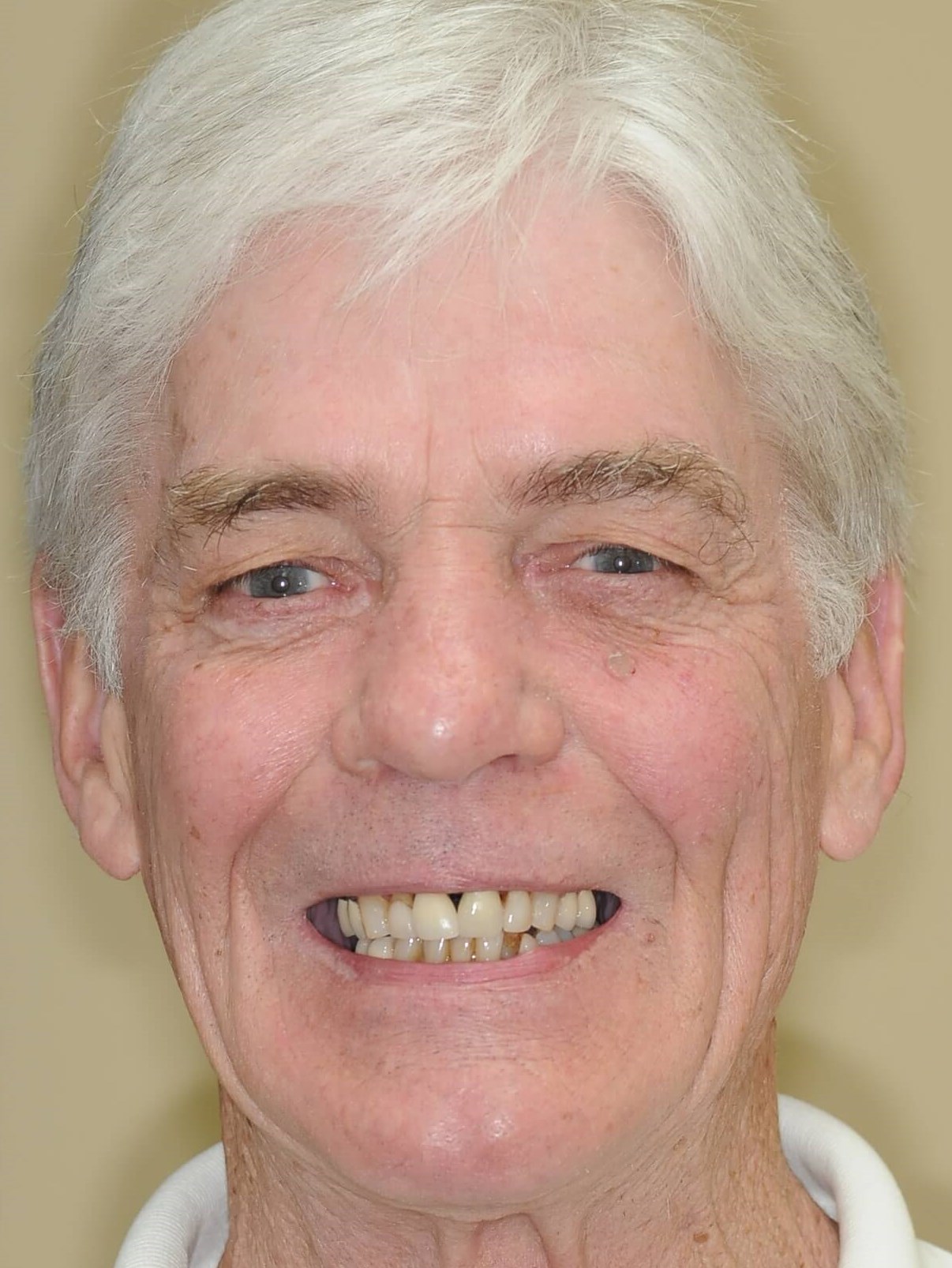 Amazing New And Natural Teeth Before