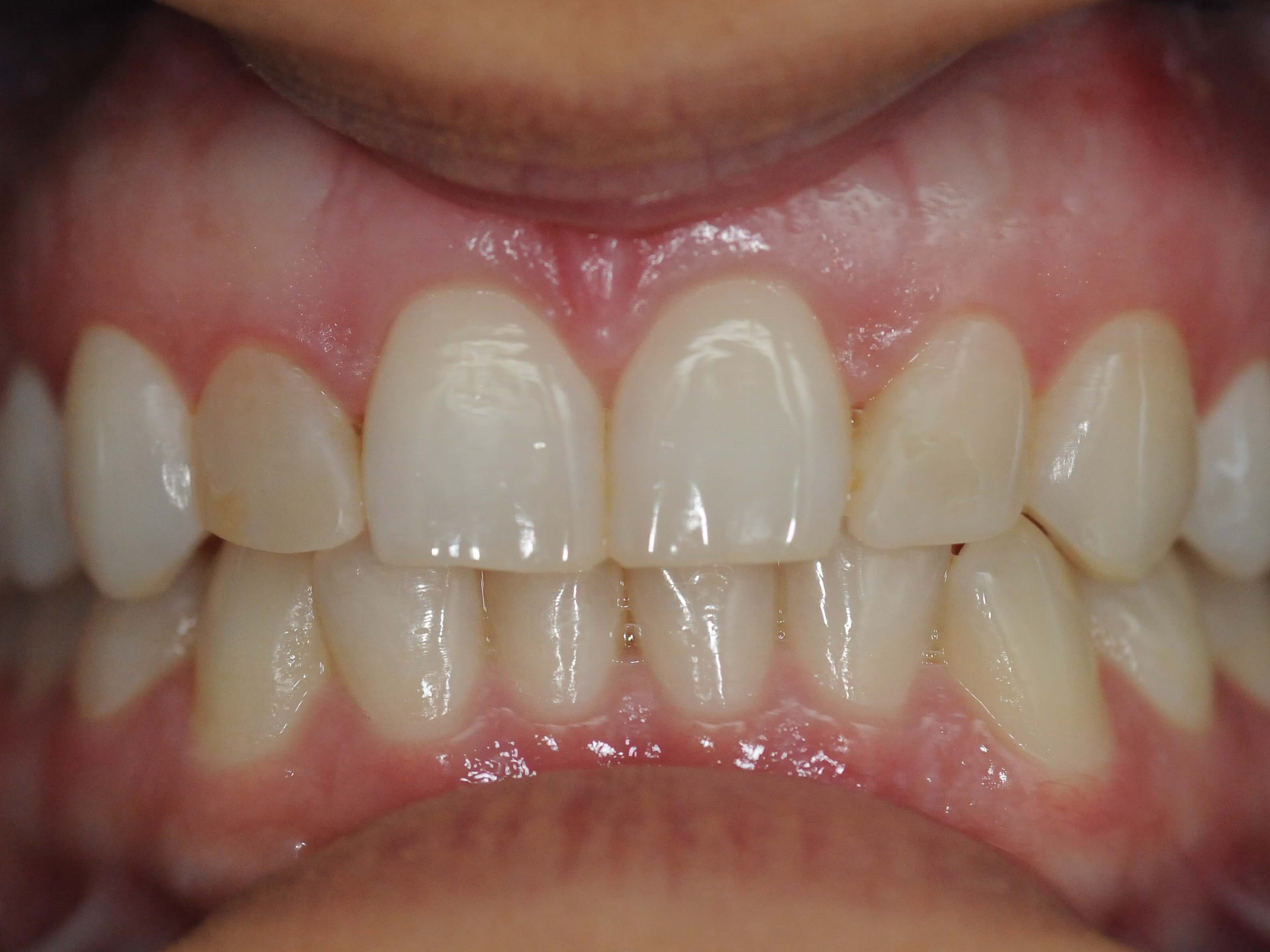 Veneers Create Smile Symmetry Before