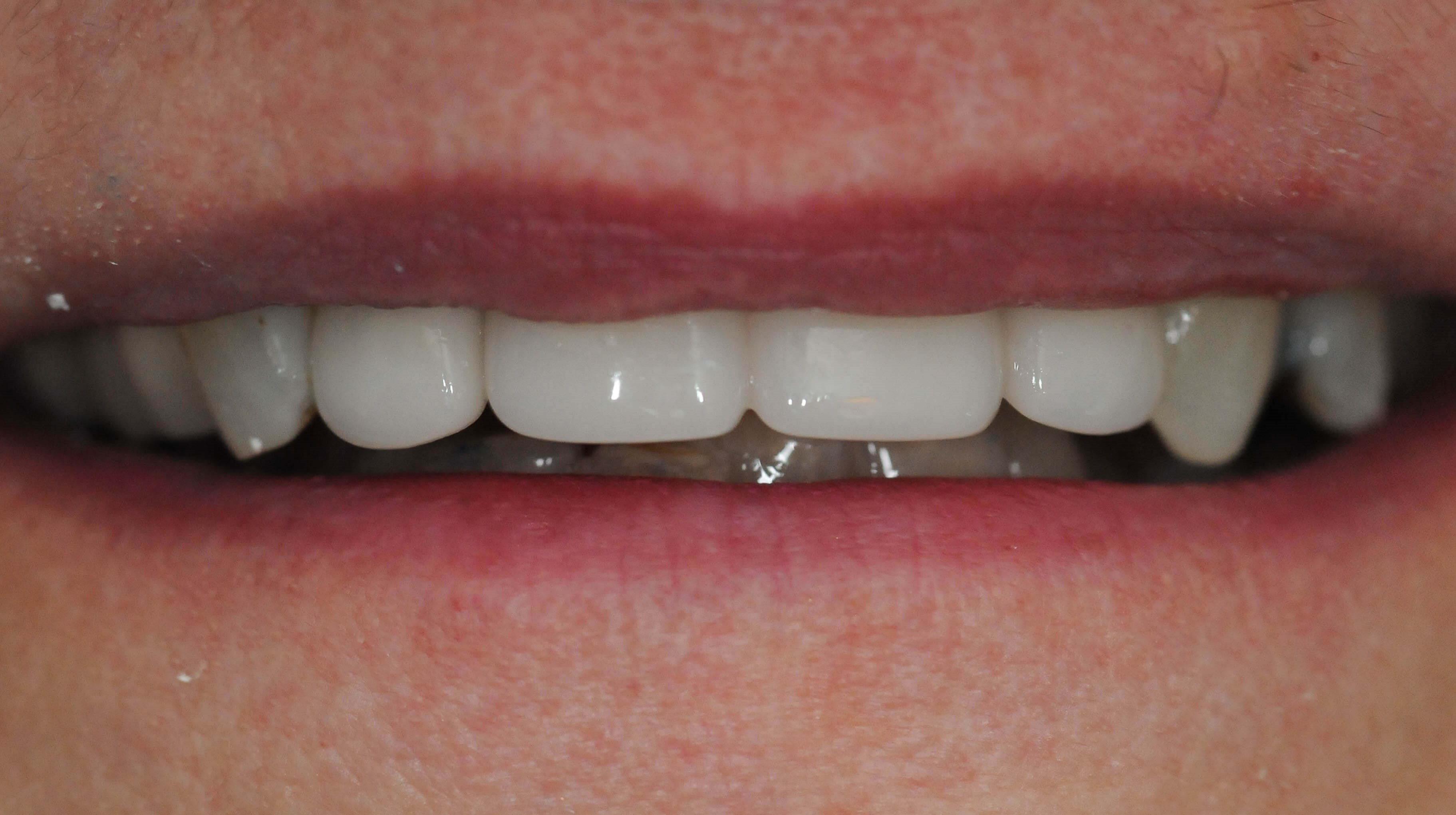 Dental bridge replacing tooth After