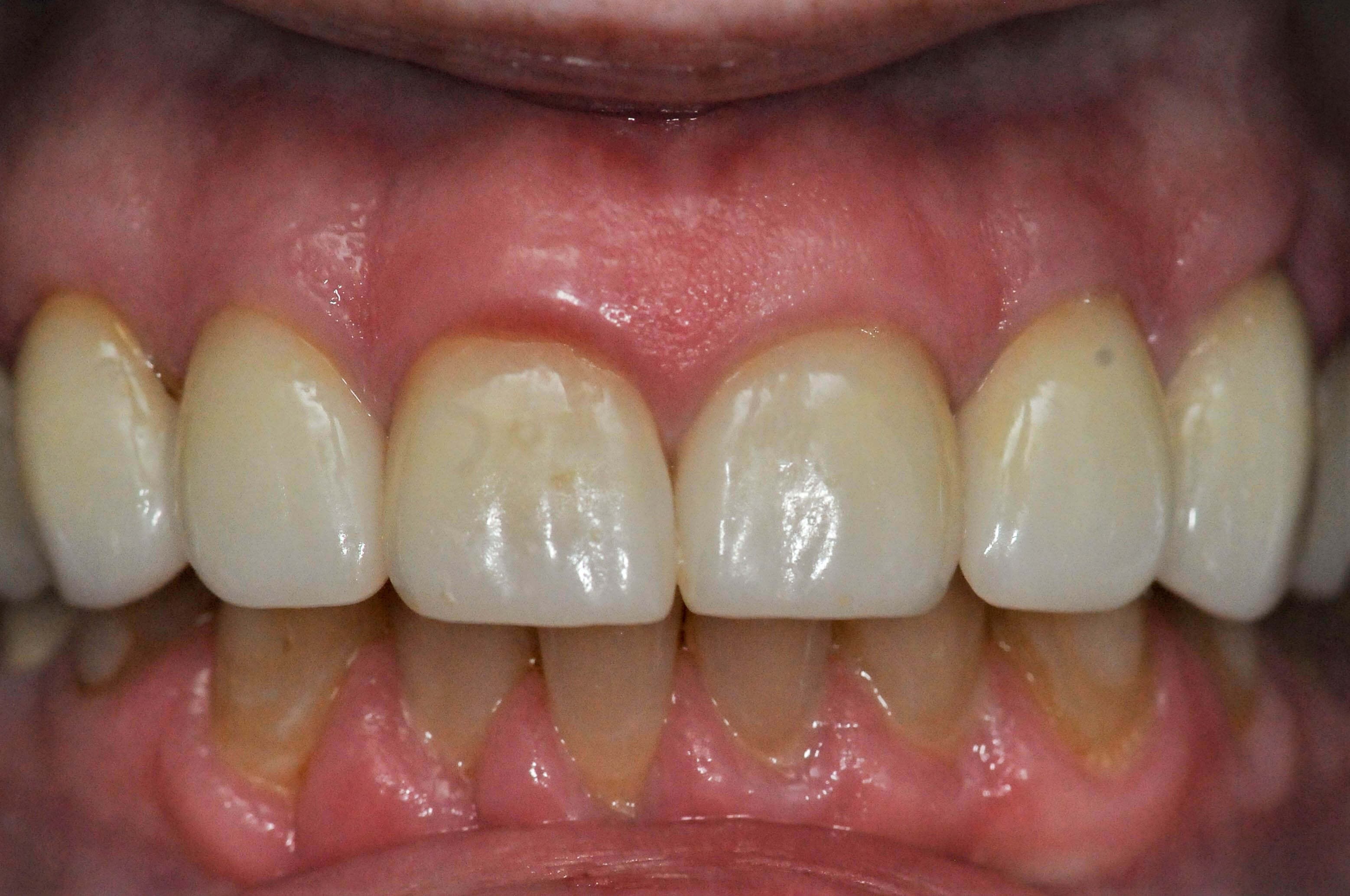 All Ceramic Crowns Before