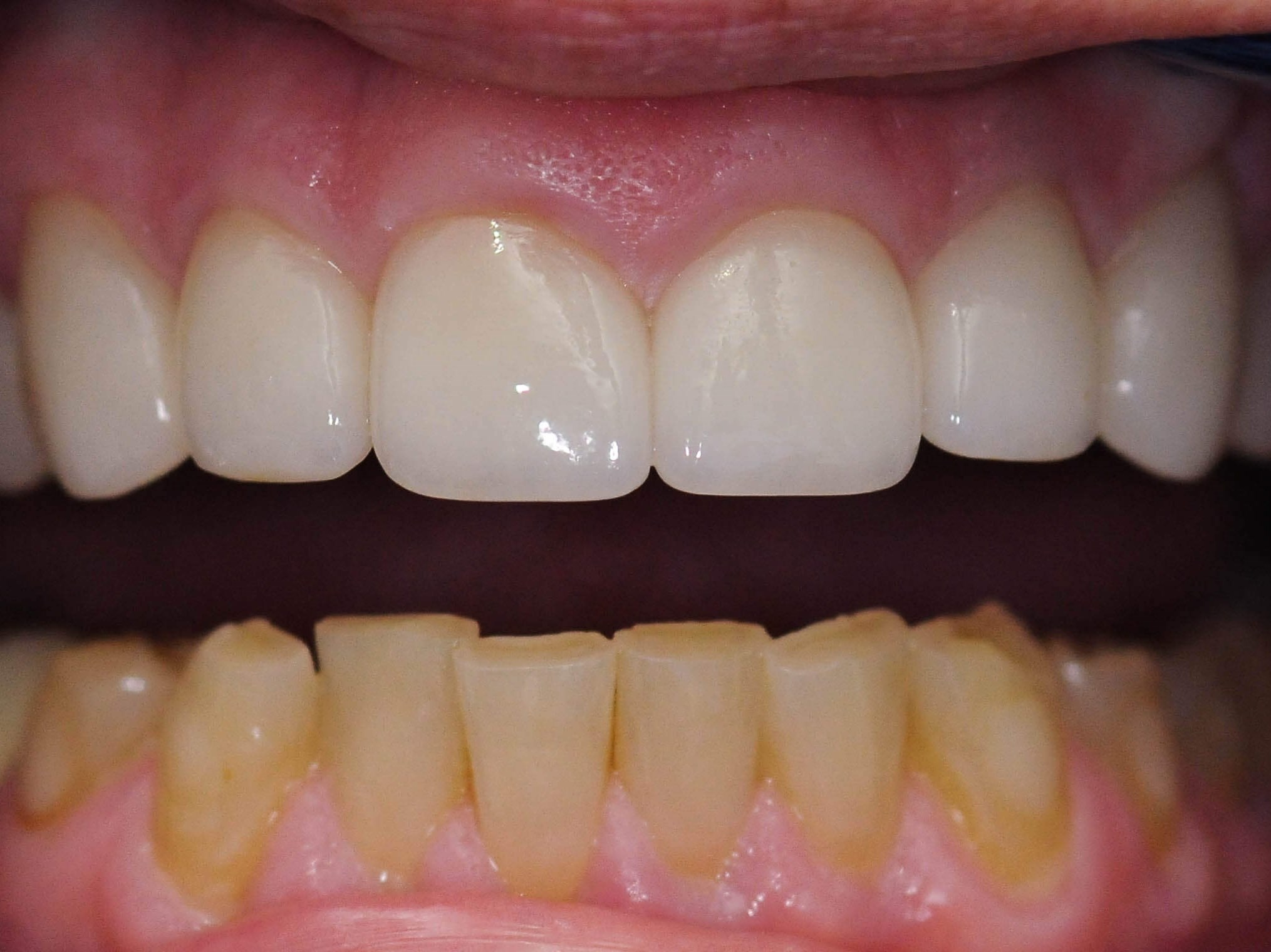 All Ceramic Crowns After
