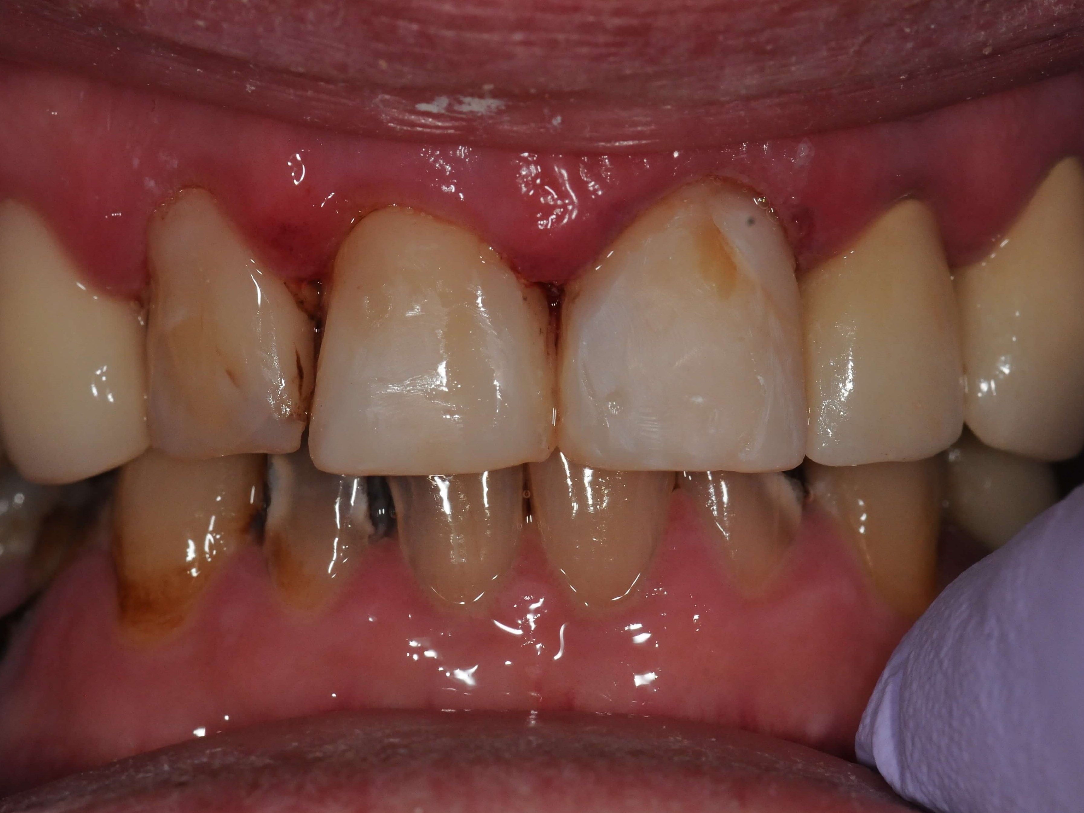 Brand New Smile Before